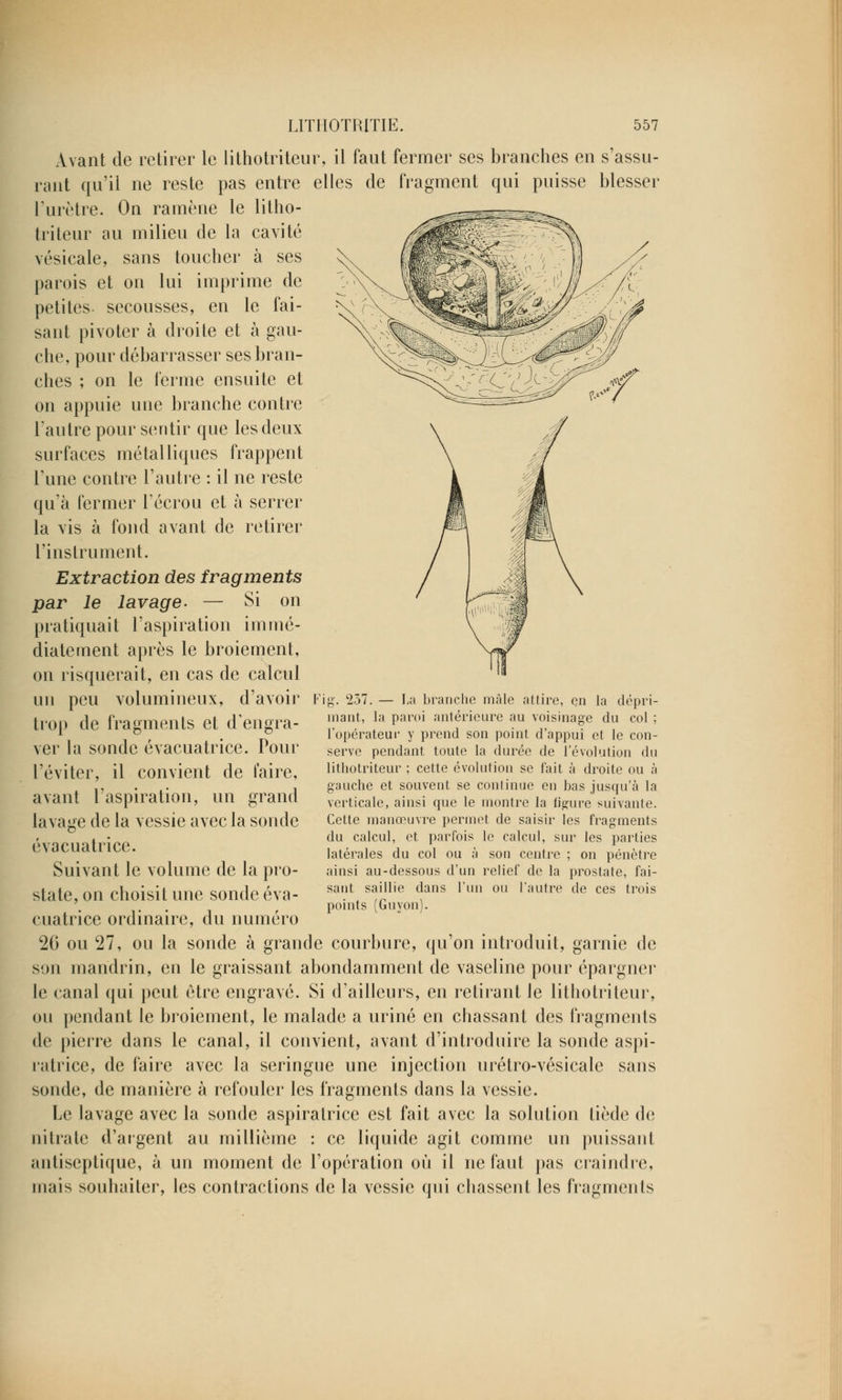 Avant de retirer le lithotriteur, il faut fermer ses branches en s'assu- rant qu'il ne reste pas entre elles de fragment qui puisse blesser l'urètre. On ramène le litho- triteur au milieu de la cavité vésicale, sans toucher à ses parois et on lui imprime de petites secousses, en le fai- sant pivoter à droite et à gau- che, pour débarrasser ses bran- ches ; on le ferme ensuite et on appuie une branche contre l'autre pour sentir que les deux surfaces métalliques frappent l'une contre l'autre : il ne reste qu'à fermer l'écrou et à serrer la vis à fond avant de retirer l'instrument. Extraction des fragments par le lavage. — Si on pratiquait l'aspiration immé- diatement après le broiement, on risquerait, en cas de calcul un peu volumineux, d'avoir trop de fragments et d'engra- ver la sonde évacuatrice. Pour l'éviter, il convient de l'aire, avant l'aspiration, un grand lavage de la vessie avec la sonde Fi g. 237. — La branche mâle attire, en la dépri- mant, la paroi antérieure au voisinage du col ; l'opérateur y prend son point d'appui et le con- serve pendant toute la durée de l'évolution du lithotriteur ; cette évolution se fait à droite ou à gauche et souvent se continue en bas jusqu'à la verticale, ainsi que le montre la figure suivante. Cette manœuvre permet de saisir les fragments du calcul, et parfois le calcul, sur les parties latérales du col ou à son centre ; on pénètre ainsi au-dessous d'un relief de la prostate, fai- sant saillie dans l'un ou l'autre de ces trois points (Guyon). évacuatrice. Suivant le volume de la pro- state, on choisit une sonde éva- cuatrice ordinaire, du numéro 26 ou 27, ou la sonde à grande courbure, qu'on introduit, garnie de son mandrin, en le graissant abondamment de vaseline pour épargner le canal qui peut être engravé. Si d'ailleurs, en retirant le lithotriteur, ou pendant le broiement, le malade a uriné en chassant des fragments de pierre dans le canal, il convient, avant d'introduire la sonde aspi- ratrice, de faire avec la seringue une injection urétro-vésicale sans sonde, de manière à refouler les fragments dans la vessie. Le lavage avec la sonde aspiratrice est fait avec la solution tiède de nitrate d'argent au millième : ce liquide agit comme un puissant antiseptique, à un moment de l'opération où il ne faut pas craindre, mais souhaiter, les contractions de la vessie qui chassent les fragments