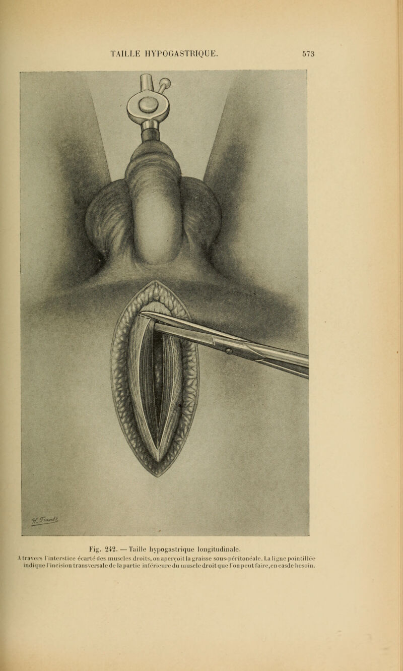 Fig. 242.— Taille hypogastrique longitudinale. \ travers l'inlerstice écartédes muscles droits, on aperçoitla graisse sous-péritonéale. La ligne pointillée indique l incision transversale de la partie inf< du muscle droit que l'on peut faire, en casde besoin.