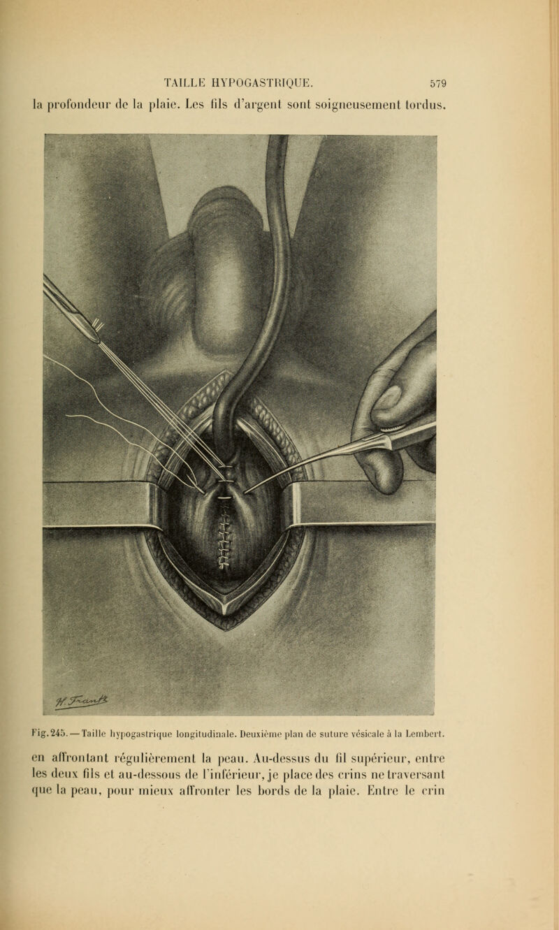 la profondeur de la plaie. Les fils d'argent sont soigneusement tordus. Fig.245. — Taille hypogastrique longitudinale. Deuxième plan de suture vésicale à la Lembert. en affrontant régulièrement la peau. Au-dessus du fîl supérieur, entre les deux fils et au-dessous de l'inférieur, je place des crins ne traversant que la peau, pour mieux affronter les bords de la plaie. Entre le crin