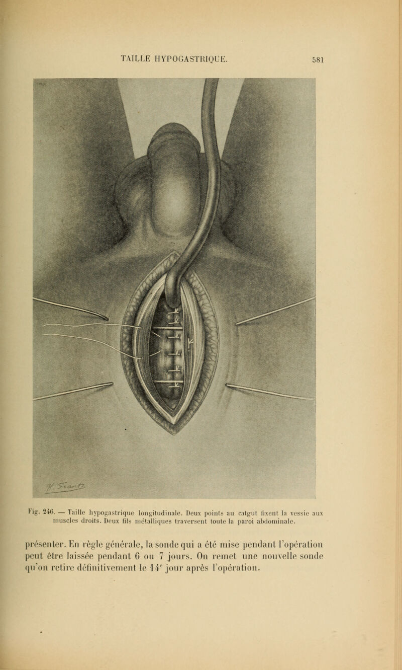 lig. 246. — Taille hypogastrique longitudinale. Deux points au catgut fixent la vessie aux muscles droits. Deux fils métalliques traversent toute la paroi abdominale. présenter. En règle générale, la sonde qui a été mise pendant l'opération peut être laissée pendant 6 ou 7 jours. On remet une nouvelle sonde qu'on retire définitivement le 14'' jour après l'opération.