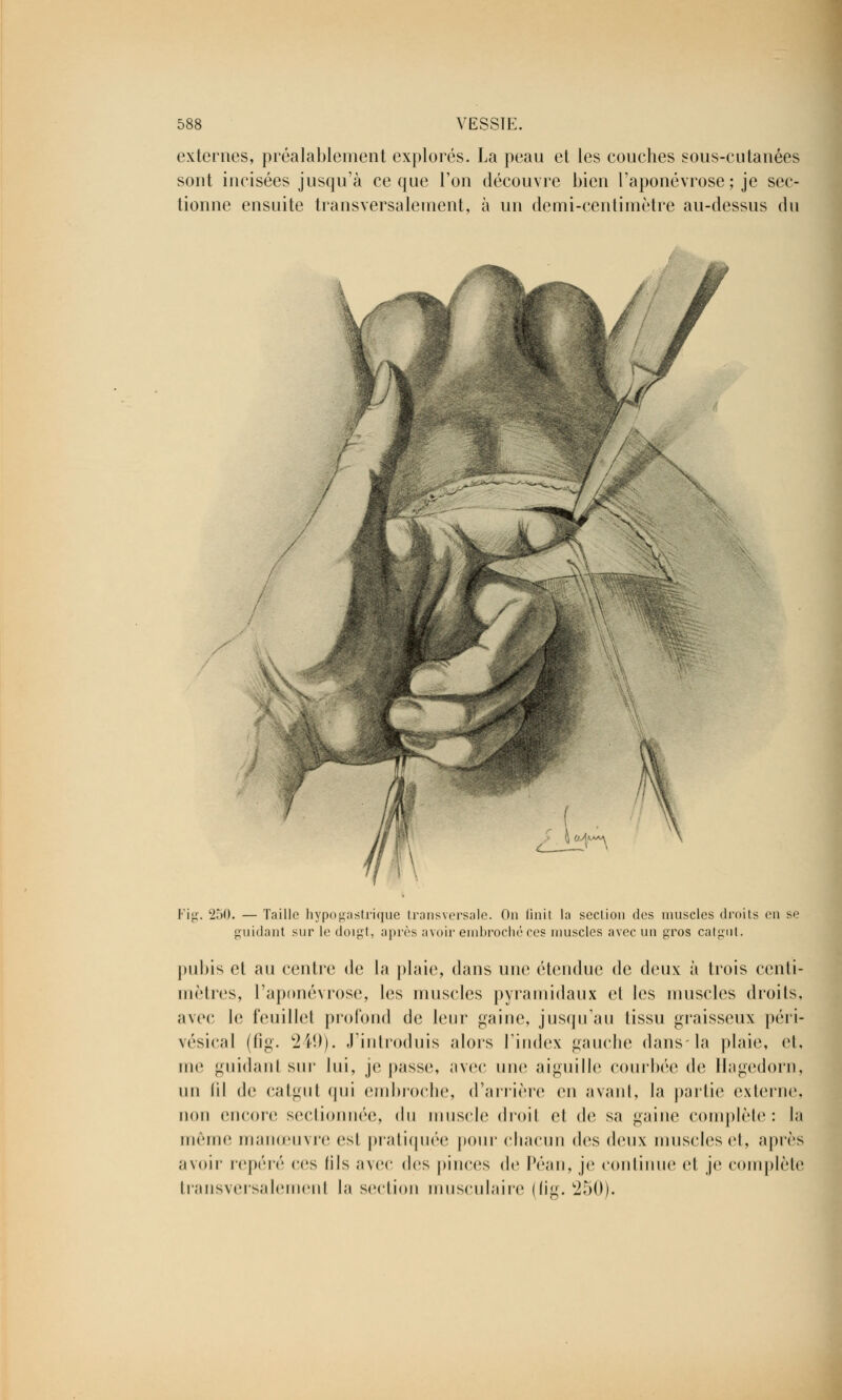 externes, préalablement explorés. La peau et les couches sous-cutanées sont incisées jusqu'à ce que l'on découvre bien l'aponévrose; je sec- tionne ensuite transversalement, à un demi-centimètre au-dessus du Fig. 250. — Taille hypogastrique transversale. On finit la section des muscles droits en se guidant sur le doigt, après avoir embroché ces muscles avec un gros catgut. pubis et au centre de la plaie, dans une étendue de deux à trois centi- mètres, l'aponévrose, les muscles pyramidaux et les muscles droits, avec h; feuillet profond de leur gaine, jusqu'au tissu graisseux péri- vésical (fig. 249). J'introduis alors ['index gauche dans-la plaie, et, me guidanl sur lui, je passe, avec une aiguille courbée de Hagedorn, un fil de catgut qui embroche, d'arrière en avant, la partie externe, non encore sectionnée, du muscle droit et de sa gaine complète: la même manœuvre est pratiquée pour chacun des deux muscles et, après avoir repéré ces (ils avec des pinces de Péan, je continue et je complète transversalement la section musculaire (fig. '250).