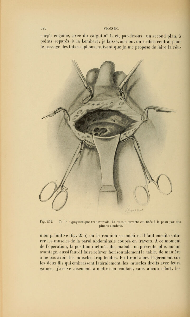 surjet engaîné, avec du catgut n° 1, et, par-dessus, un second plan, à points séparés, à la Lembert ; je laisse, ou non, un orifice central pour le passage des tubes-siphons, suivant que je me propose de faire la réu- Fig. 252. — Taille liypogastrique transversale. La vessie ouverte est fixée à la peau par des pinces coudées. nion primitive (fig. 255) ou la réunion secondaire. Il faut ensuite sutu- rer les musclesde la paroi abdominale coupés en travers. A ce momenl de l'opération, la position inclinée du malade ne présente plus aucun avantage, aussi faut-il fairerelever horizontalement la table, de manière à m; pas avoir les muscles trop tendus. En tirant alors légèrement sur les deux fils qui embrassent Latéralement les muscles droits avec leurs gaines, j'arrive aisément à mettre en contact, sans aucun effort, les