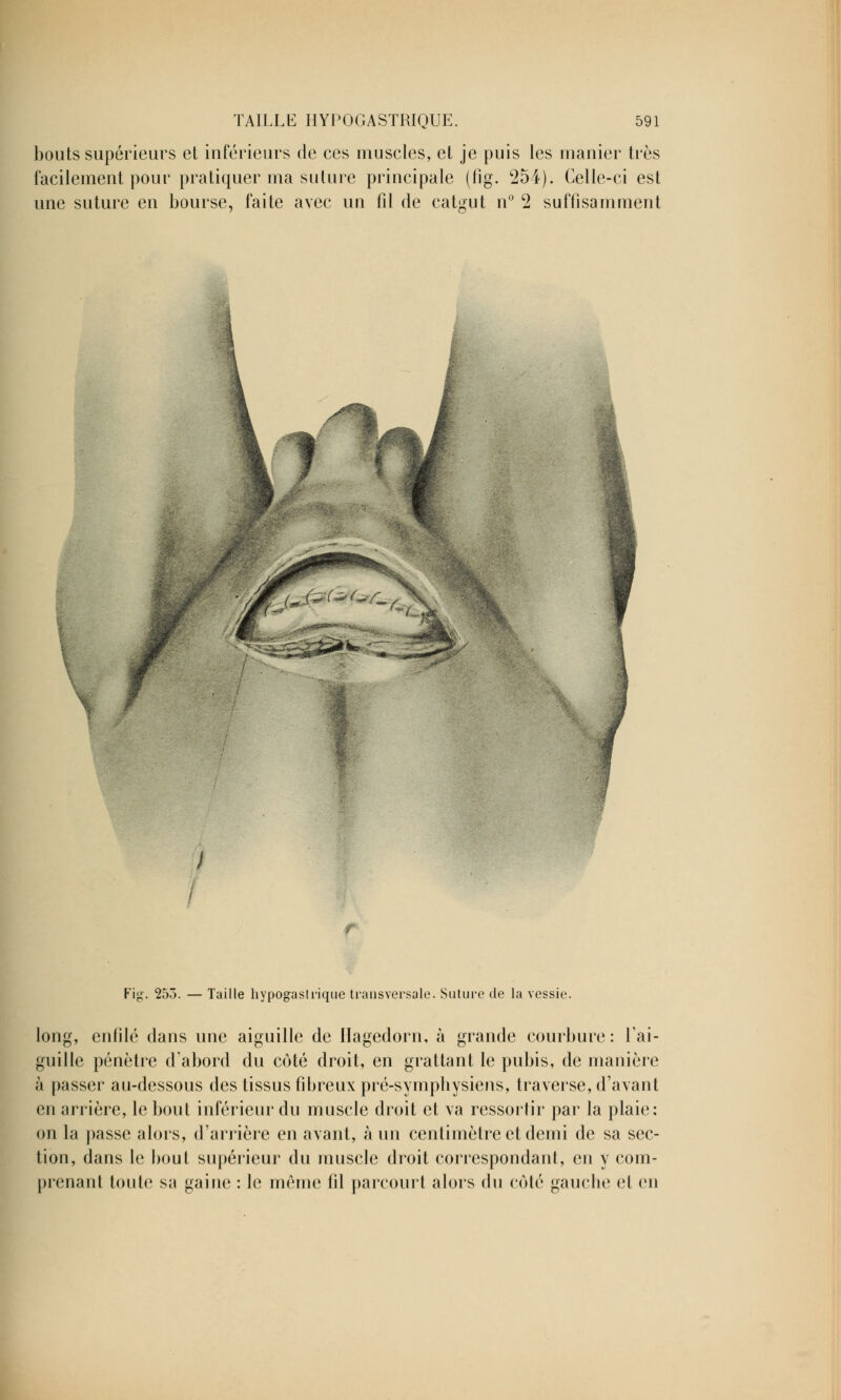 bouts supérieurs et inférieurs de ces muscles, et je puis les manier très facilement pour pratiquer ma suture principale (fig. 254). Celle-ci est une suture en bourse, faite avec un fil de catgut n° 2 suffisamment O/: N. Fig. 255. — Taille hypogastrique transversale. Suture de la vessie. grande courbure : ai long, enfilé dans une aiguille de ilagedorn, à gui lie pénètre d'abord du côté droit, en grattant le pubis, de manière à passer au-dessous des tissus fibreux pré-sympbysiens, traverse, d'avant en arrière, le bout inférieur du muscle droit et va ressortir par la plaie: on la passe alors, d'arrière en avant, à un centimètre et demi de sa sec- tion, dans le bout supérieur du muscle droit correspondant, en y com- prenant toute sa gaine : le même fil parcourt alors du côté gauche et en