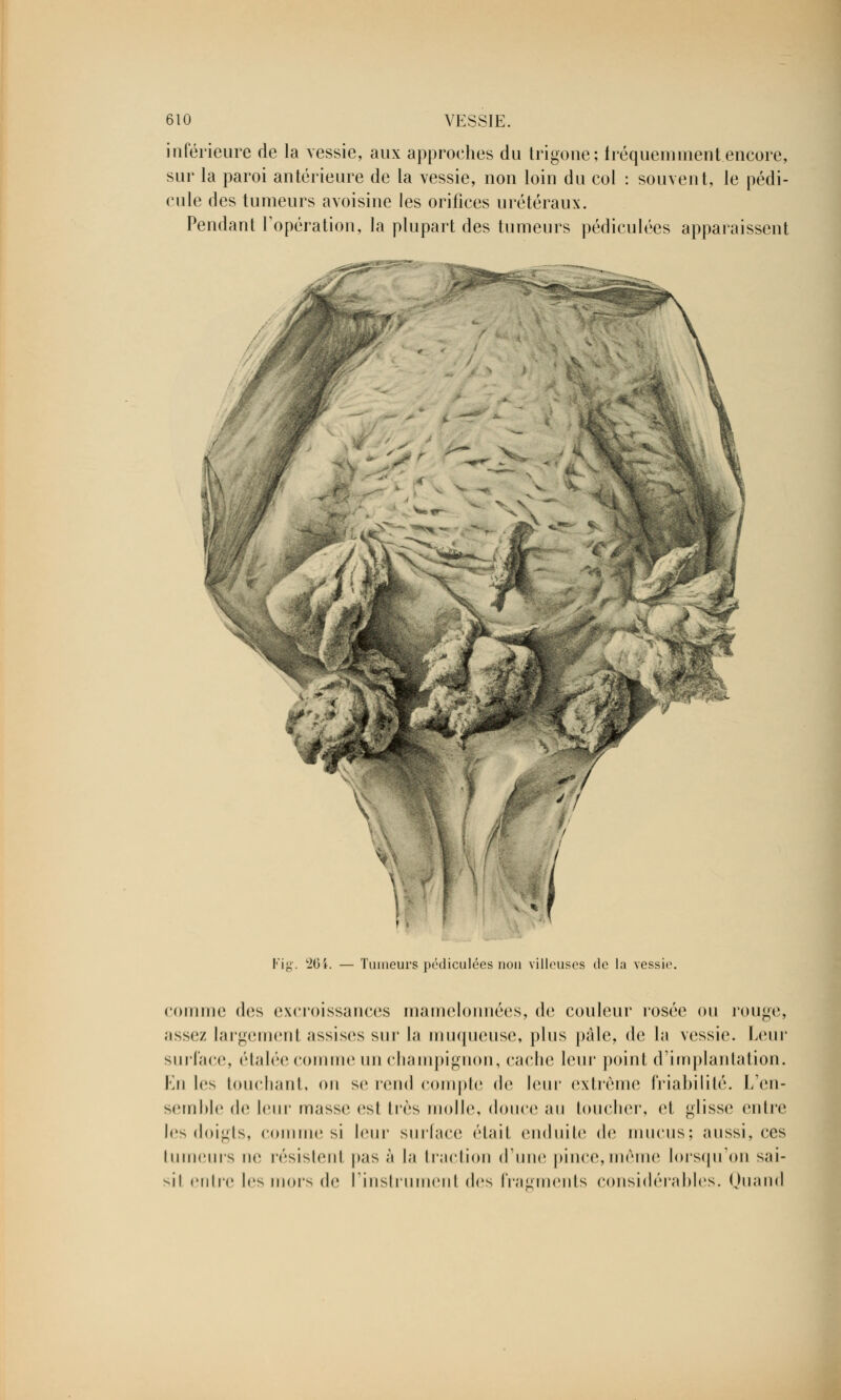 inférieure de la vessie, aux approches du trigone; fréquemment encore, sur la paroi antérieure de la vessie, non loin du col : souvent, le pédi- cule des tumeurs avoisine les orifices urétéraux. Pendant l'opération, la plupart des tumeurs pédiculées apparaissent ■•20\. — Tumeurs pédiculées non villeuses tic la vessie. comme dos excroissances mamelonnées, de couleur' rosée ou rouge, assez largement assises sur la moqueuse, plus pale, de la vessie. Leur surface, étalée comme un champignon, cache leur point d'implantation. En les touchant, on se rond compte de leur extrême friabilité. L'en- semble de leur masse es1 très molle, douce au toucher, el glisse entre les doigts, comme si leur surface était enduite de mucus; aussi, ces tumeurs ne résistenl pas à la traction d'une pince,même lorsqu'on s;ii- sii entre les mors de l'instrument dos fragments considérables. Quand