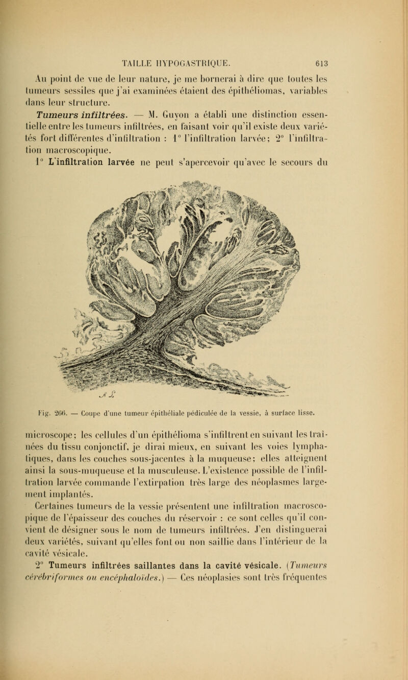 Au point de vue de leur nature, je me bornerai à dire que toutes les tumeurs sessiles que j'ai examinées étaient des épithéliomas, variables dans leur structure. Tumeurs infiltrées. — M. Guyon a établi une distinction essen- tielle entre les tumeurs infiltrées, en taisant voir qu'il existe deux varié- tés fort différentes d'infiltration : 1° l'infiltration larvée; 2° l'infiltra- tion macroscopique. 1° L'infiltration larvée ne peut s'apercevoir qu'avec le secours du Fig. 266. — Coupe d'une tumeur épithéliale pédiculée de la vessie, à surface lisse. microscope; les cellules d'un épithélioma s'infiltrent en suivant les traî- nées du tissu conjonctif, je dirai mieux, en suivant les voies lympha- tiques, dans les couches sous-jacentes à la muqueuse; elles atteignent ainsi la sous-muqueuse et la musculeuse. L'existence possible de l'infil- tration larvée commande l'extirpation très large des néoplasmes large- ment implantés. Certaines tumeurs de la vessie présentent une infiltration macrosco- pique de l'épaisseur des couches du réservoir : ce sont celles qu'il con- vient de désigner sous le nom de tumeurs infiltrées. J'en distinguerai deux variétés, suivant qu'elles font ou non saillie dans l'intérieur de la cavité vésicale. 2° Tumeurs infiltrées saillantes dans la cavité vésicale. (Tumeurs cérébri formes ou encéphaloïdes.) — Ces néoplasies sont très fréquentes