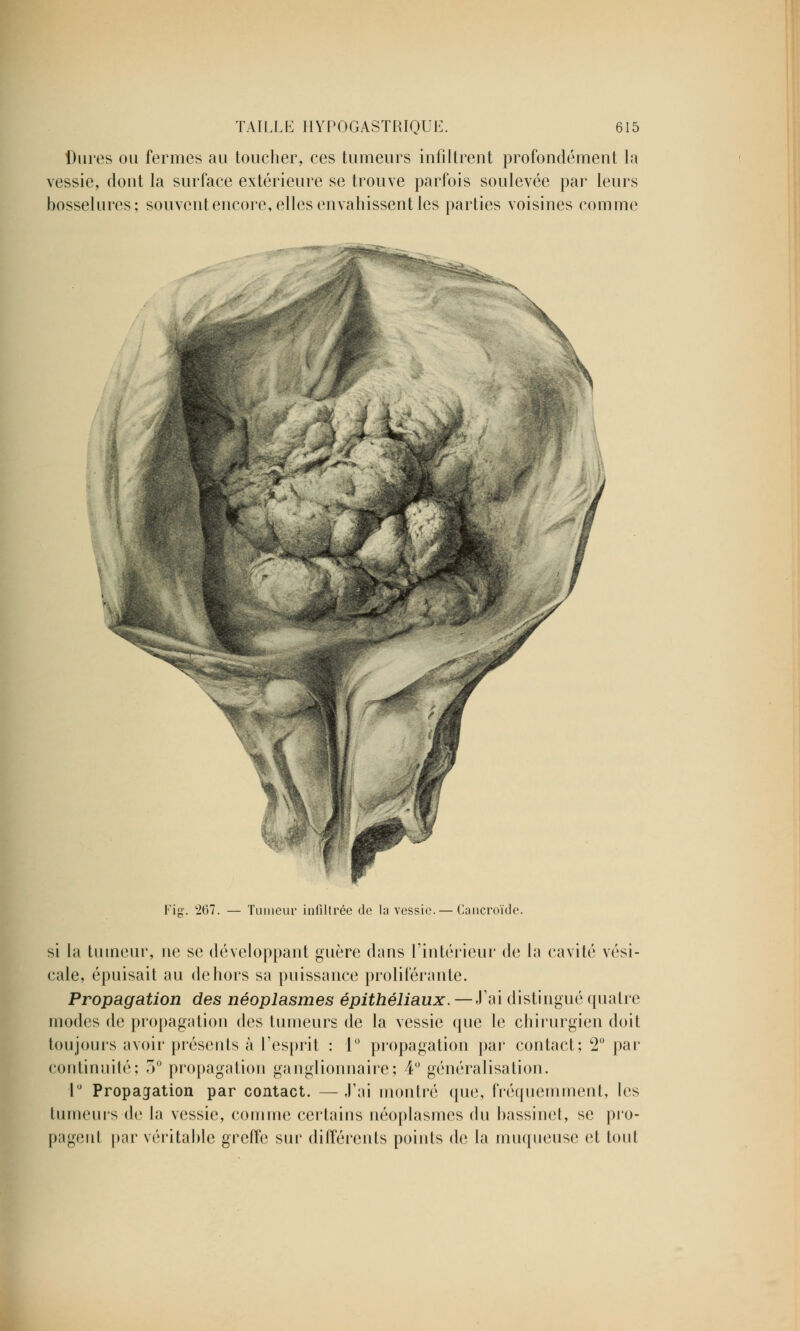 Dures ou fermes au toucher, ces tumeurs infiltrent profondément la vessie, dont la surface extérieure se trouve parfois soulevée par leurs bosselures; souvent encore, elles envahissent les parties voisines comme \ \ / Fiff. 267. — Tumeur infiltrée de la vessie.— Cancroïde. si la tumeur, ne se développant guère dans l'intérieur de la cavité vési- cale, épuisait au dehors sa puissance proliférante. Propagation des néoplasmes épithéliaux. — J'ai distingué quatre modes de propagation des tumeurs de la vessie que le chirurgien doit toujours avoir présents à l'esprit : 1° propagation par contact; 2° par continuité; 3° propagation ganglionnaire; 4° généralisation. 1° Propagation par contact. — J'ai montré que, fréquemment, les tumeurs de la vessie, comme certains néoplasmes du bassinet, se pro- pagent pur véritable greffe sur différents points de la muqueuse et tout
