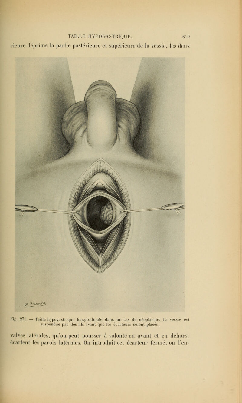 rieure déprime la partie postérieure et supérieure de la vessie, les deux Fig. 271.— Taille hypogastrique longitudinale dans un cas de néoplasme. La vessie est suspendue par des fils avant que les écarteurs soient placés. valves latérales, qu'on peut pousser à volonté en avant et eu dehors, écartent les parois latérales. On introduit cet écarteur fermé, on Feu-