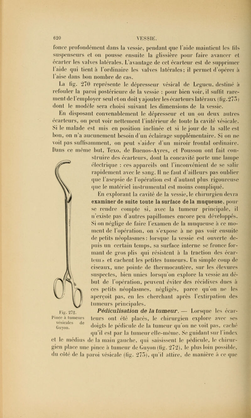 fonce profondément dans la vessie, pendant que l'aide maintient les iils suspenseurs et on pousse ensuite la glissière pour faire avancer et écarter les valves latérales. L'avantage de cet écarteur est de supprimer l'aide qui tient à l'ordinaire les valves latérales; il permet d'opérer à l'aise dans bon nombre de cas. La fig. 270 représente le dépresseur vésical de Legueu, destiné à refouler la paroi postérieure de la vessie : pour bien voir, il suffit rare- ment de l'employer seul et on doit y ajouter les écarteurs latéraux (fîg.273 ) dont le modèle sera choisi suivant les dimensions de la vessie. En disposant convenablement le dépresseur et un ou deux autres écarteurs, on peut voir nettement l'intérieur de toute la cavité vésicale. Si le malade est mis en position inclinée et si le jour de la salle est bon, on n'a aucunement besoin d'un éclairage supplémentaire. Si on ne voit pas suffisamment, on peut s'aider d'un miroir frontal ordinaire. Dans ce même but, Texo, de Buenos-Ayres, et Pousson ont fait con- struire des écarteurs, dont la concavité porte une lampe électrique : ces appareils ont l'inconvénient de se salir rapidement avec le sang. Il ne faut d'ailleurs pas oublier que l'asepsie de l'opération est d'autant plus rigoureuse (pie le matériel instrumental est moins compliqué. En explorant la cavité de la vessie, le chirurgien devra examiner de suite toute la surface delà muqueuse, pour se rendre compte si, avec la tumeur principale, il n'existe pas d'autres papillomes encore peu développés. Si on néglige de faire l'examen de la muqueuse à ce mo- ment de l'opération, on s'expose à ne pas voir ensuite de petits néoplasmes : lorsque la vessie est ouverte de- puis un certain temps, sa surface interne se fronce for- mant de gros plis qui résistent à la traction des écar- teuia et cachent les petites tumeurs. Un simple coup de ciseaux, une pointe de thermocautère, sur les élevures suspectes, bien unies lorsqu'on explore la vessie au dé- but de l'opération, peuvent éviter des récidives dues à ces petits néoplasmes, négligés, parce (pion ne les ;iperçoit pas, en les cherchant après l'extirpation des tumeurs principales. Pédiculisation de la tumeur.— Lorsque les écar- teurs ont élé placés, le chirurgien explore avec ses doigts le pédicule de la tumeur qu'on ne voit pas, caché qu'il esl parla lumeur elle-même. Se guidant sur l'index el le médius de la main gauche, qui saisissent le pédicule, le chirur- gien place une pince à tumeur de (iiiyon (fig. 272), le plus loin possible, du côté de la paroi vésicale (fig. 273), qu'il attire, de manière à ce que Fig. 272. Pince à tumeurs vésicales de (jllVOII.