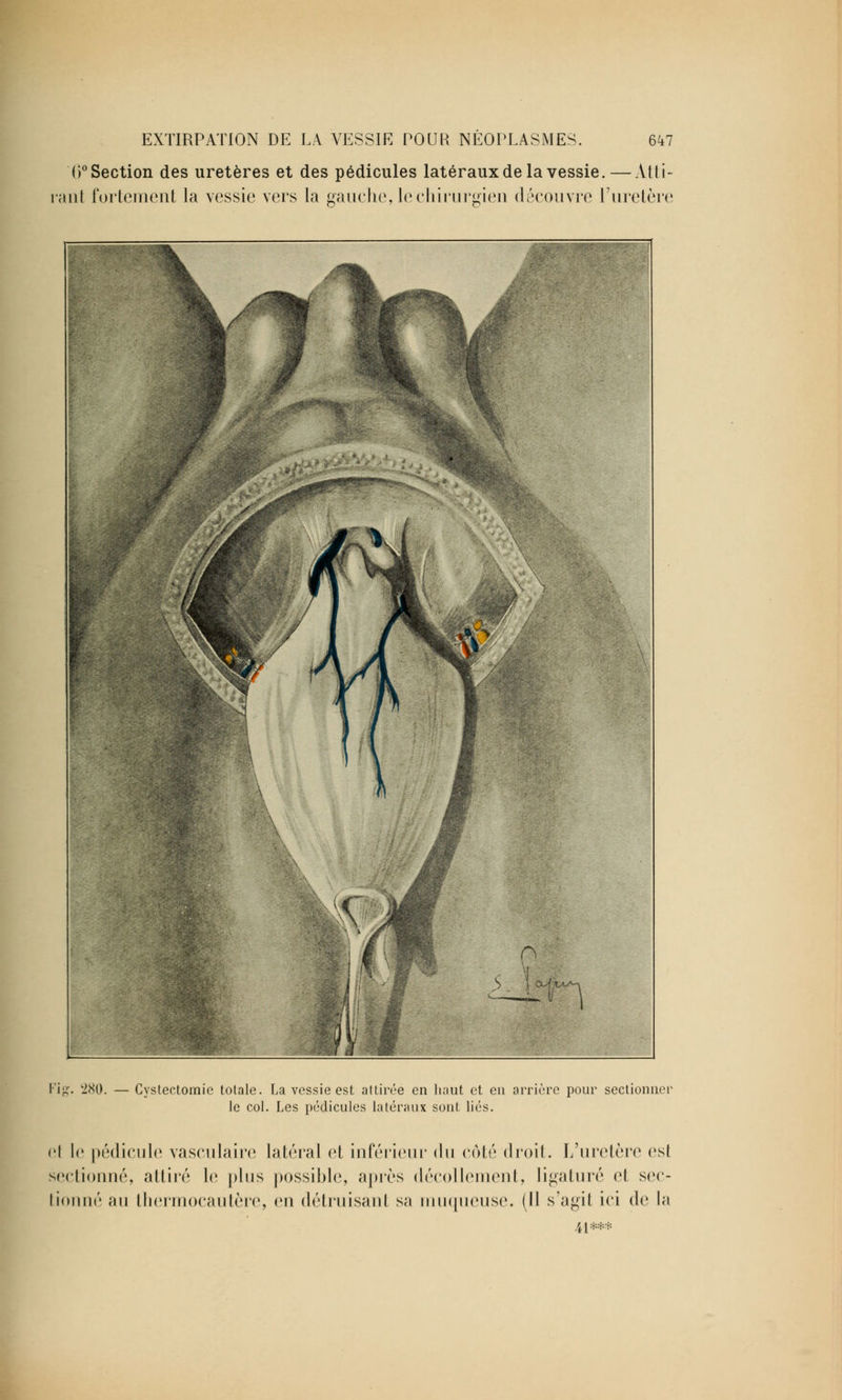 0° Section des uretères et des pédicules latéraux de la vessie. — Atti- rant fortement la vessie vers la gauche, le chirurgien découvre l'uretère Fig. 280. Cystectomie totale. La vessie est attirée en haut et en arrière pour sectionnei le col. Les pédicules latéraux sont lies. el le pédicule vasculaire latéral et inférieur du côté droit. L'uretère esl sectionné, attiré le plus possible, après décollement, ligaturé el sec- tionné au thermocautère, en détruisant sa muqueuse. (Il s'agit ici de la 41***