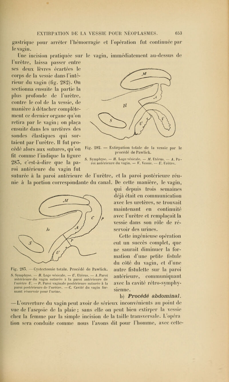 gastrique pour arrêter l'hémorragie et l'opération fut continuée par' le vagin. mmédiatement au-dessus de ie vagin. Fig. 282. — Extirpation totale de la vessie par le procédé de Pawlick. S. Symphyse. — H. Loge vésicale. — M. Utérus. — A. Pa- roi antérieure du vagin. — V. Vessie. — U. Urètre. Une incision pratiquée sui l'urètre, laissa passer entre ses deux lèvres écartées le corps de la vessie dans l'inté- rieur du vagin (fig. 282). On sectionna ensuite la partie la plus profonde de l'urètre, contre le col de la vessie, de manière à détacher complète- ment ce dernier organe qu'on retira par le vagin ; on plaça ensuite dans les uretères des sondes élastiques qui sor- taient par l'urètre. 11 fut pro- cédé alors aux sutures, qu'on fit comme l'indique la figure 283, c'est-à-dire que la pa- roi antérieure du vagin fut suturée à la paroi antérieure de l'urètre, et la paroi postérieure réu- nie à la portion correspondante du canal. De cette manière, le vagin, qui depuis trois semaines déjà était en communication avec les uretères, se trouvait maintenant en continuité avec l'urètre et remplaçait la vessie dans son rôle de ré- servoir des urines. Cette ingénieuse opération eut un succès complet, que ne saurait diminuer la for- mation d'une petite fistule du coté du vagin, et d'une autre fistulette sur la paroi antérieure, communiquant avec la cavité rétro-symphy- sienne. b) Procédé abdominal. — L'ouverture du vagin peut avoir de sérieux inconvénients au poiut de vue de l'asepsie de la plaie; sans elle on peut bien extirper la vessie chez la femme par la simple incision de la taille transversale. L'opéra lion sera conduite comme nous l'avons dit pour l'homme, avec cette- Fig. 283. —Cystectomie totale. Procédé de Pawlick. S. Symphyse. — //. Loge vésicale. — U. Utérus. — A. Paroi antérieure du vagin suturée à la paroi antérieure de l'urètre U. — P. Paroi vaginale postérieure suturée à la paroi postérieure de l'urètre. — C. Cavité du vagin for- mant réservoir pour l'urine.