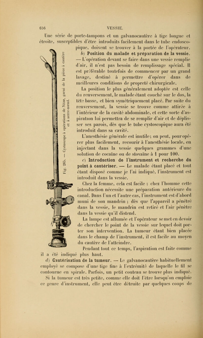 Une série de porte-tampons et un galvanocautère à tige longue et étroite, susceptibles d'être introduits facilement dans le tube endosco- pique, doivent se trouver à la portée de l'opérateur. b) Position du malade et préparation de la vessie. — L'opération devant se faire dans une vessie remplie d'air, il n'est pas besoin de remplissage spécial. 11 est préférable toutefois de commencer par un grand lavage, destiné à permettre d'opérer dans de meilleures conditions de propreté chirurgicale. La position le plus généralement adoptée est celle du renversement, le malade étant couché sur le dos, la tète basse, et bien symétriquement placé. Par suite du renversement, la vessie se trouve comme attirée à l'intérieur de la cavité abdominale, et cette sorte d'as- piration lui permettra de se remplir d'air et de déplis- ser ses parois, dès que le tube cystoscopique aura été introduit dans sa cavité. L'anesthésie générale est inutile; on peut, pour opé- rer plus facilement, recourir à l'anesthésie locale, en injectant dans la vessie quelques grammes d'une solution de cocaïne ou de stovaïne à 1 pour 100. c) Introduction de l'instrument et recherche du point à cautériser. — Le malade étant placé et tout étant disposé comme je l'ai indiqué, l'instrument est introduit dans la vessie. Chez la femme, cela est facile ; chez l'homme cette introduction nécessite une préparation antérieure du canal. Dans l'un et l'autre cas, l'instrument est d'abord muni de son mandrin ; dès que l'appareil a pénétré dans la vessie, le mandrin est retiré et l'air pénètre dans la vessie qu'il distend. La lampe est allumée et l'opérateur se met en devoir de chercher le point de la vessie sur lequel doit por- ter son intervention. La tumeur étant bien placée dans le champ de l'instrument, il est facile au moyen du cautère de l'atteindre. Pendant tout ce temps, l'aspiration est faite comme été indiqué plus haut. (I) Cautérisation de la tumeur. — Le galvanocautère habituellement employé se compose d'une tige; fine à l'extrémité de Laquelle le lil se contourne en spirale. Parfois, un petit couteau se trouve plus indiqué. Si la tumeur est très petite, comme elle doit l'être lorsqu'on emploie <■<■ genre d'instrument, elle peut être détruite par quelques coups de il