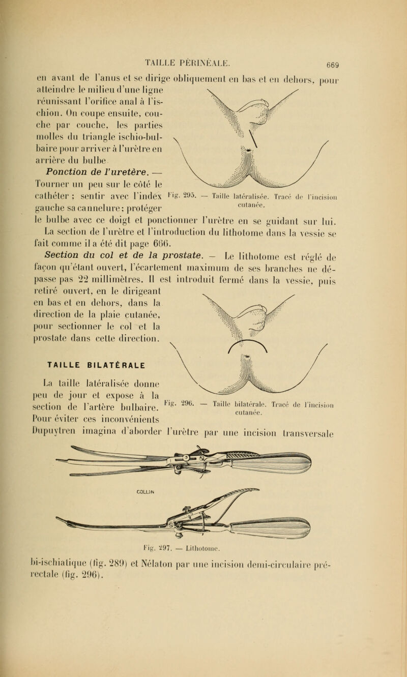 pour Taille latéralisée, cutanée. Tracé de l'incisioi TAILLE PÉRINÉALE. eu avant de l'anus et se dirige obliquement en bas et en dehor atteindre le milieu d'une ligne réunissant l'orifice anal à l'is- chion. On coupe ensuite, cou- che par couche, les parties molles du triangle ischio-bul- baire pour arriver à l'urètre en arrière du bulbe Ponction de l'uretère. — Tourner un peu sur le côté le cathéter ; sentir avec l'index ' 'n- 205- gauche sa cannelure; protéger le bulbe avec ce doigt et ponctionner l'urètre en se guidant sur lui. La section de l'urètre et l'introduction du lithotome dans la vessie se fait comme il a été dit page 666. Section du col et de la prostate. - Le lithotome est réglé de façon qu'étant ouvert, l'écartement maximum de ses branches ne dé- passe pas 22 millimètres. Il est introduit fermé dans la vessie, puis retiré ouvert, en le dirigeant en bas et en dehors, dans la direction de la plaie cutanée, pour sectionner le col et la prostate dans cette direction. TAILLE BILATÉRALE La taille latéralisée donne peu de jour et expose à la section de l'artère bulbaire. Pour éviter ces inconvénients Dupuytren imagina d'aborder l'urètre par une incision transversale Fis. 296. Taille bilatérale. Tracé de l'incision cutanée. Fig. '297. — Lithotome. bi-ischiatique (lïg. 28!)) et Nélaton par une incision demi-circulaire pré rectale (fig. 296).