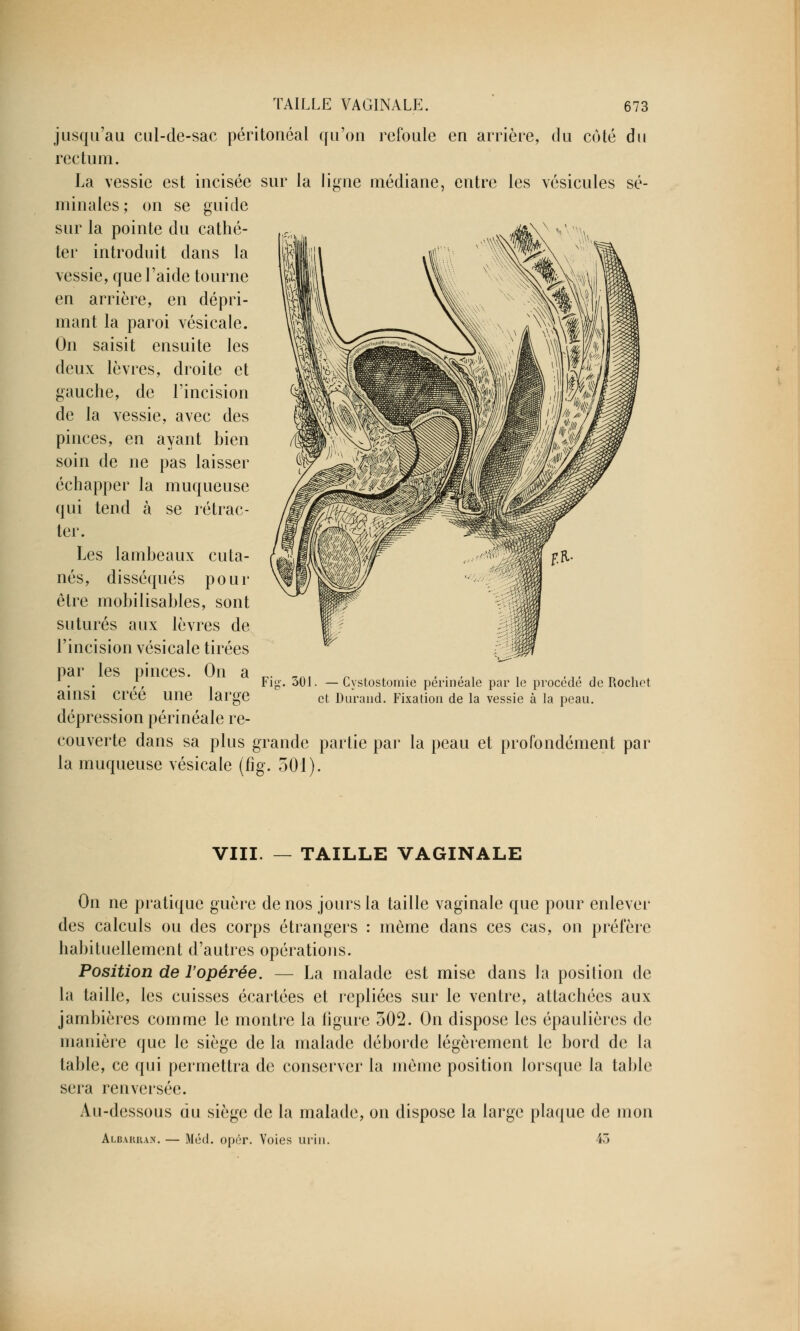 jusqu'au cul-de-sac péritonéal qu'on refoule en arrière, du côté du rectum. La vessie est incisée sur la ligne médiane, entre les vésicules sé- minales; on se guide sur la pointe du cathé- ter introduit dans la vessie, que l'aide tourne en arrière, en dépri- mant la paroi vésicale. On saisit ensuite les deux lèvres, droite et gauche, de l'incision de la vessie, avec des pinces, en ayant bien soin de ne pas laisser échapper la muqueuse qui tend à se rétrac- ter. Les lambeaux cuta- nés, disséqués pour être mobilisables, sont suturés aux lèvres de l'incision vésicale tirées par les pinces. On a ainsi créé une large dépression périnéale re- couverte dans sa plus grande partie par la peau et profondément pa la muqueuse vésicale (fîg. 501). Fi« 301. —Gystostomie périnéale par le procédé de Rochet et Durand. Fixation de la vessie à la peau. VIII. TAILLE VAGINALE On ne pratique guère de nos jours la taille vaginale que pour enlever des calculs ou des corps étrangers : même dans ces cas, on préfère habituellement d'autres opérations. Position de l'opérée. — La malade est mise dans la position de la taille, les cuisses écartées et repliées sur le ventre, attachées aux jambières comme le montre la ligure 302. On dispose les épaulières de manière que le siège de la malade déborde légèrement le bord de la table, ce qui permettra de conserver la même position lorsque la table scia renversée. Au-dessous du siège de la malade, on dispose la large plaque de mon Albarkan. — Méd. opér. Voies urin. 43