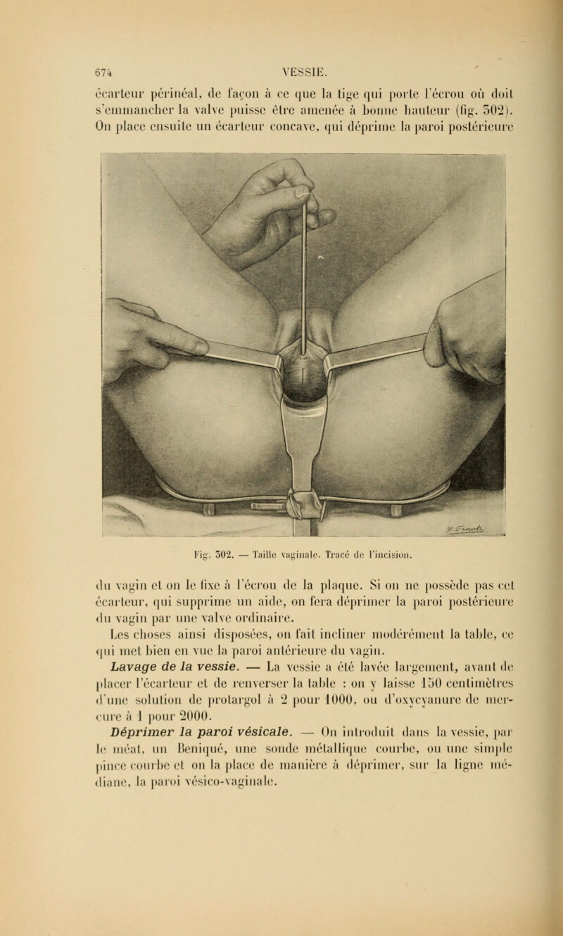 écarteur périnéal, de façon à ce que la tige qui porte l'écrou où doit s'emmancher la valve puisse être amenée à bonne hauteur (fig. 502). On place ensuite un écarteur concave, qui déprime la paroi postérieure Fig. 302. — Taille vaginale. Tracé de l'incision. du vagin et on le fixe à l'écrou de la plaque. Si on ne possède pas cet écarteur, qui supprime un aide, on fera déprimer la paroi postérieure < 111 vagin par une valve ordinaire. Les choses ainsi disposées, on fait incliner modérément la table, ce qui met bien en vue la paroi antérieure du vagin. Lavage de la vessie. — La vessie a été lavée largement, avant de placer i'écarteur et de renverser la table : on y laisse 150 centimètres d'une solution de protargol à 2 pour 1000, ou d'oxycyanure de mer- cure à 1 pour 2000. Déprimer la paroi vésicale. — On introduit dans la vessie, par le méat, un Beniqué, une sonde métallique courbe, ou une simple pince courbe et ou la place de manière à déprimer, sur la ligne mé- dii , la paroi vésico-vaginale.