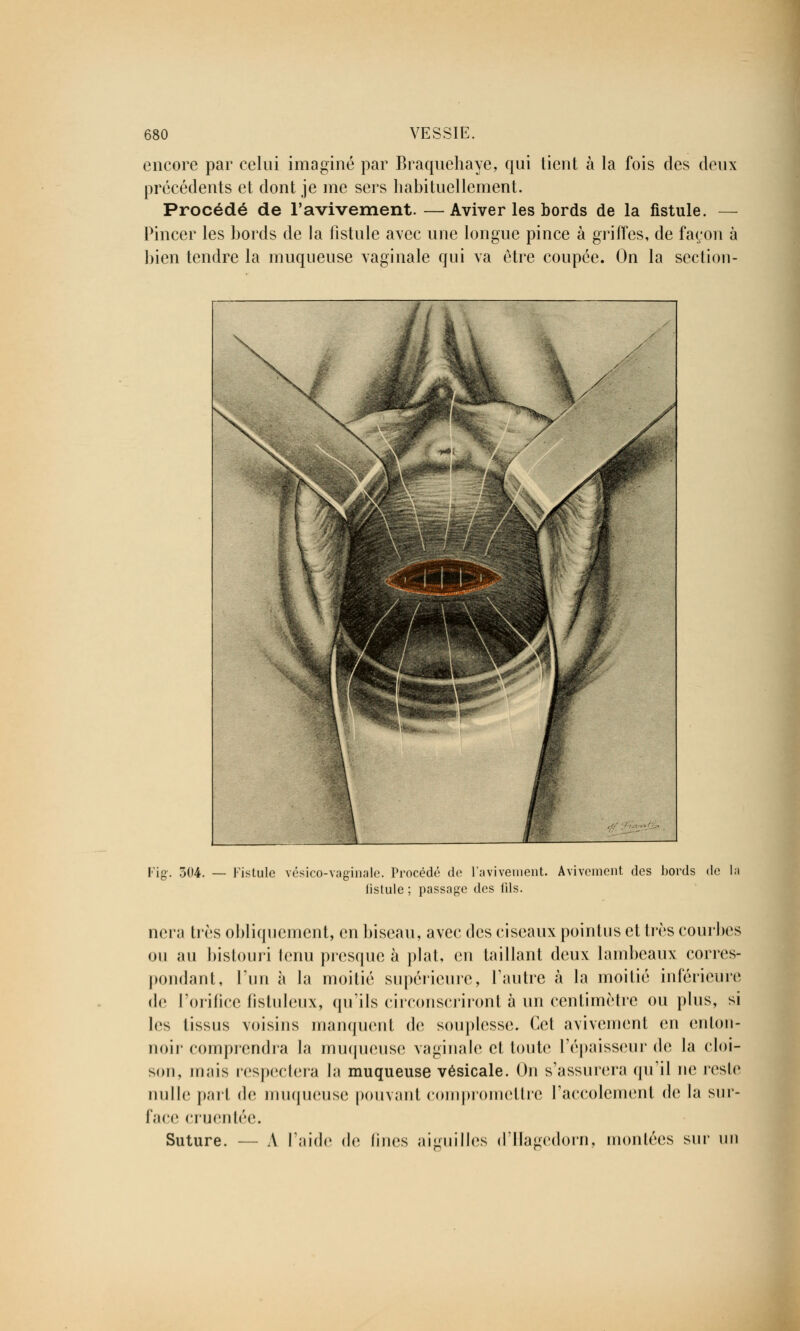 encore par celui imaginé par Braquehaye, qui tient à la fois des deux précédents et dont je me sers habituellement. Procédé de l'avivement. —Aviver les bords de la fistule. — Pincer les bords de la fistule avec une longue pince à griffes, de façon à bien tendre la muqueuse vaginale qui va être coupée. On la section - 304. — Fistule vésico-vaginale. Procédé do l'avivement. Avivement dos bords de la listule ; passage des lils. nera très obliquement, en biseau, avec des ciseaux pointus et très courbes ou au bistouri tenu presque à plat, en taillant deux lambeaux corres- pondant, l'un à la moitié supérieure, l'autre à la moitié inférieure de l'orifice fistuleux, qu'ils circonscriront à un centimètre ou plus, si les tissus voisins manquent de souplesse. Cet avivement en enton- noir comprendra la muqueuse vaginale cl toute l'épaisseur de la cloi- son, mais respectera \<\ muqueuse vésicale. On s'assurera qu'il ne reste nulle part de muqueuse pouvant compromettre l'accolement de la sur- face cruentée. Suture. — A l'aide de Unes aiguilles d'Haeedorn, moulées sur un
