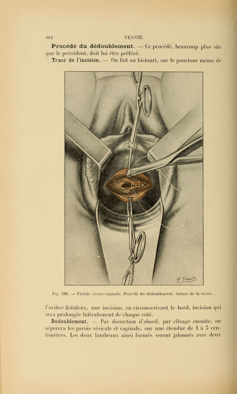 Procédé du dédoublement. — Ce procédé, beaucoup plus sûr <pic le précédent, doit lui être préféré. Tracé de l'incision. — On fait au bistouri, sur le pourtour même de Fis. r>0G. — Fistule vésico-vaeinale. Procédé du dédoublement. Sulure de la vessie l'orifice fistuleux, une incision, en circonscrivant le bord, incision qui sera prolongée latéralement (\r chaque côté. Dédoublement. Par dissection d'abord, par clivage ensuite, on séparera les parois vésicale cl vaginale, sur une étendue de I à 3 cen- timètres. Les deux lambeaux ainsi formés seront jalonnés avec deux