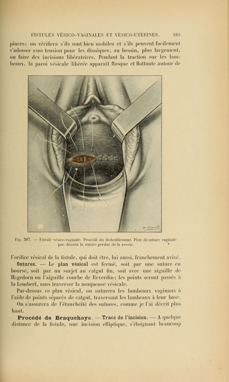 pinces; on vérifiera s'ils sont bien mobiles el s'ils peuvent facilemenl s'adosser sans tension pour les disséquer, au besoin, pins largement, on faire des incisions libératrices. Pendant la traction sur les lam- beaux, la paroi vésicale libérée apparaît flasque et flottante autour de 307. — Fistule vésico-vaginale. Procédé du dédoublement. Plan de suture vaginale par-dessus la suture perdue de la vessie. w l'orifice vésical de la fistule, qui doit être, lui aussi, franchement avivé. Sutures. — Le plan vésical est fermé, soit par une suture en bourse, soit par un surjet au catgut fin, soit avec une aiguille de Hagedorn ou l'aiguille courbe de Reverdin ; les points seront passés à la Lembert, sans traverser la muqueuse vésicale. Par-dessus ce plan vésical, on suturera les lambeaux vaginaux à l'aide de points séparés de catgut, traversant les lambeaux à leur base. On s'assurera de l'étanchéité des sutures, comme je l'ai décrit plus haut. Procédé de Braquehaye. — Tracé de l'incision. — A quelque distance de la fistule, une incision elliptique, s'éloignant beaucoup