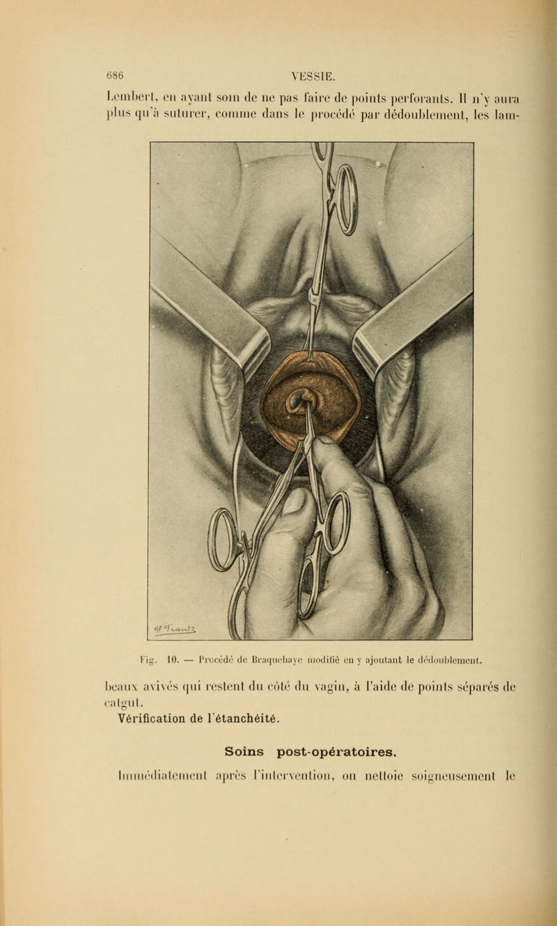 Lembert, en ayant soin de ne pas faire de points perforants. 11 n'y aura plus qu'à suturer, comme dans le procédé par dédoublement, les lam- Fig. 10. — Procédé do Braquehaye modifié en y ajoutant le dédoublement. Iieaux avivés qui restent du côté du vagin, à l'aide de points séparés de atgut. Vérification de Tétanchéité. Soins post-opératoires. Immédiatement après l'intervention, on nettoie soigneusement le