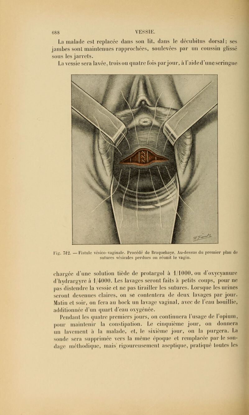 La malade est replacée dans son lit, dans le décubitus dorsal; ses jambes sont maintenues rapprochées, soulevées par un coussin glissé sous les jarrets. La vessie sera lavée, trois ou quatre fois par joue, à l'aide d'une seringue Fig. 312. —Fistule vésico-vaginalè. Procédé de Braquehaye. Au-dessus du premier plan de sutures vésicales perdues on réunit le vagin. chargée d'une solution tiède de protargol à 1/1000, ou d'oxycyanure d'hydrargyre à 1/4000. Les lavages seront faits à petits coups, pour ne pas distendre la vessie et ne pas tirailler les sutures. Lorsque les urines seront devenues claires, on se contentera de deux lavages par jour. Matin et soie, on fera au bock un lavage vaginal, avec de l'eau bouillie, additionnée d'un quart d'eau oxygénée. Pendant les quatre premiers jours, on continuera l'usage de l'opium, pour maintenir la constipation. Le cinquième jour, on donnera un lavement à la malade, et, le sixième jour, on la purgera. La sonde sera supprimée vers la même époque et remplacée par le son- dage méthodique, mais rigoureusement aseptique, pratiqué toutes les