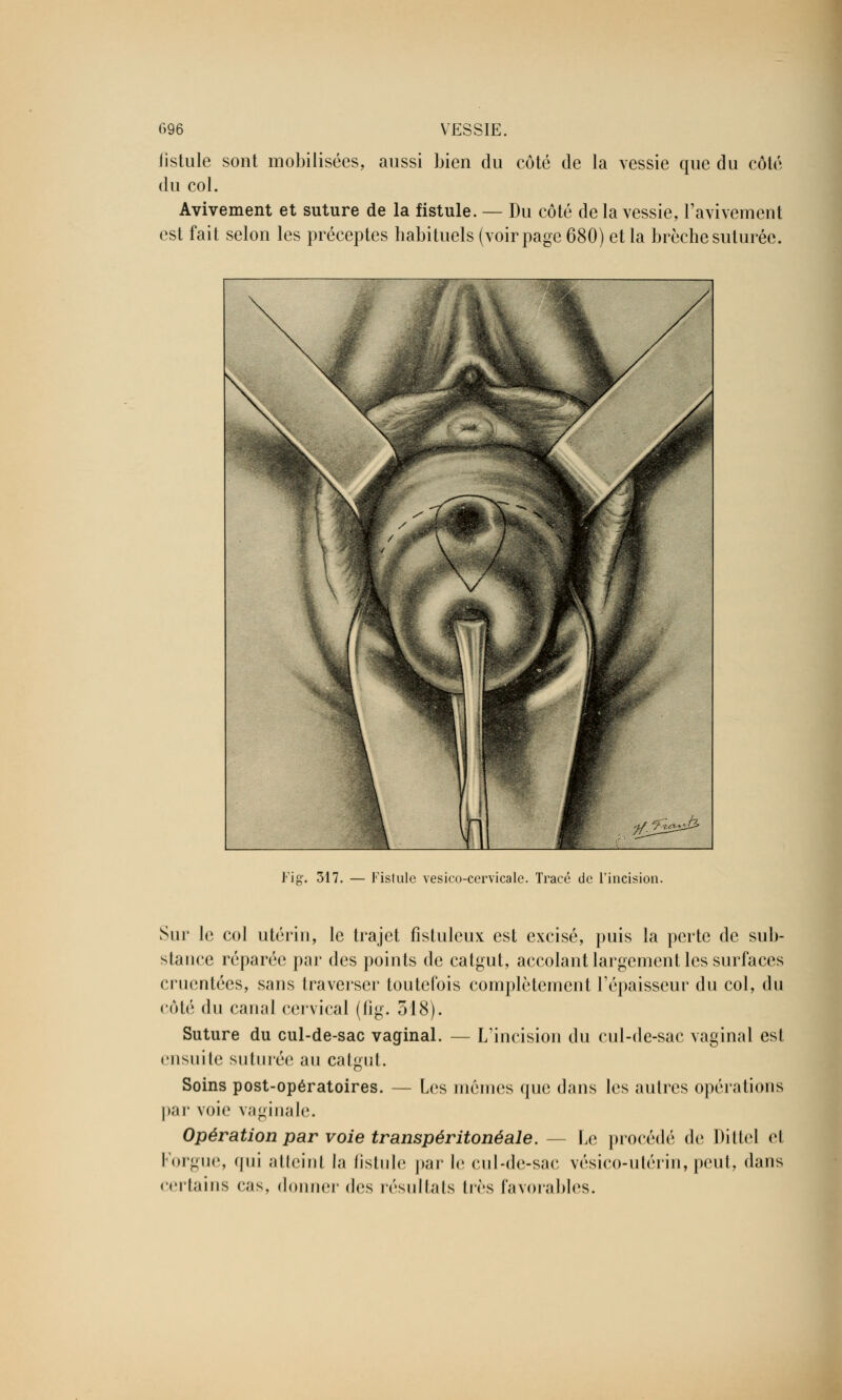 fistule sont mobilisées, aussi bien du côté de la vessie que du côté du col. Avivement et suture de la fistule. — Du côté de la vessie, l'avivement est fait selon les préceptes habituels (voir page 680) et la brèche suturée. Fie. 317. Fislule vesico-cervicale. Tracé de l'incision. Sur le col utérin, le trajet fisluleux est excisé, puis la perte de sub- stance réparée par des points de catgut, accolant largement les surfaces cruentées, sans traverser toutefois complètement l'épaisseur du col, du côté du canal cervical (fig. 318). Suture du cul-de-sac vaginal. — L'incision du cul-de-sac vaginal est ensuite suturée au catgut. Soins post-opératoires. — Les mômes que dans les autres opérations par voie vaginale. Opération par voie transpéritonéale. -■■ Le procédé de Dittel el l'orgue, qui atteint la fistule par le cul-de-sac vésico-utérin, peut, dans certains cas, donner des résultats très favorables.