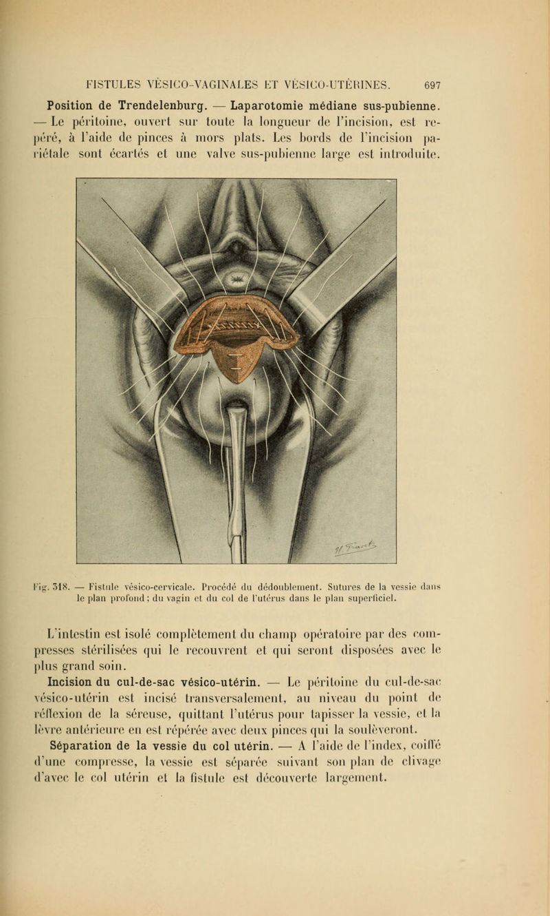 Position de Trendelenburg. — Laparotomie médiane sus-pubienne. — Le péritoine, ouvert sur toute la longueur de l'incision, est re- péré, à l'aide de pinces à mors plats. Les bords de l'incision pa- riétale sont écartés et une valve sus-pubienne large est introduite. Fig. 318. — Fistule vésico-cervicale. Procédé du dédoublement. Sutures de la vessie dans le plan profond ; du vagin et du col de l'utérus dans le plan superficiel. L'intestin est isolé complètement du champ opératoire par des com- presses stérilisées qui le recouvrent et qui seront disposées avec le plus grand soin. Incision du cul-de-sac vésico-utérin. — Le péritoine du cul-de-sac vésico-utérin est incisé transversalement, au niveau du point de réflexion de la séreuse, quittant l'utérus pour tapisser la vessie, et la lèvre antérieure en est repérée avec deux pinces qui la soulèveront. Séparation de la vessie du col utérin. — A l'aide de l'index, coiffé d'une compresse, la vessie est séparée suivant son plan de clivage d'avec le col utérin et la fistule est découverte largement.