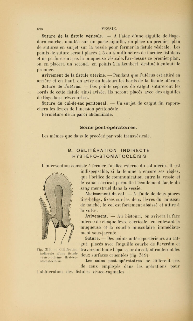 Suture de la fistule vésicale. — A l'aide d'une aiguille de Hage- dorn courbe, montée sur un porte-aiguille, on place un premier plan de sutures en surjet sur la vessie pour fermer la fistule vésicale. Les points de suture seront placés à 5 ou 4 millimètres de l'orifice fistuleux et ne perforeront pas la muqueuse vésicale. Par-dessus ce premier plan, on en placera un second, en points à la Lembert, destiné à enfouir le premier. Avivement de la fistule utérine. — Pendant que l'utérus est attiré en arrière et en haut, on avive au bistouri les bords de la fistule utérine. Suture de l'utérus. — Des points séparés de catgut sutureront les bords de cette fistule ainsi avivée. Ils seront placés avec des aiguilles de Hagedorn très courbes. Suture du cul-de-sac péritonéal. — Un surjet de catgut fin rappro- chera les lèvres de l'incision péritonéale. Fermeture de la paroi abdominale. Soins post-opératoires. Les mêmes que dans le procédé par voie transvésicale. B. OBLITERATION INDIRECTE HYSTÉRO-STOMATOCLÉISIS L'intervention consiste à fermer l'orifice externe du col utérin. Il esl indispensable, si la femme a encore ses règles, que l'orifice de communication entre la vessie et le canal cervical permette l'écoulement facile du sang menstruel dans la vessie. Abaissement du col. — A l'aide de deux pinces tire-balles, fixées sur les deux lèvres du museau de tanche, le col est fortement abaissé et attiré à la vulve. Avivement. — Au bistouri, on avivera la face interne de chaque lèvre cervicale, en enlevant la muqueuse et la couche musculaire immédiate- ment sous-jacente. Suture. — Des points antéro-postérieurs au cat- gut, placés avec l'aiguille courbe do Reverdin et IraviTsanl toute l'épaisseur du col, affronteront les deux surfaces cruentées (fig. 319). Les soins post-opératoires ne diffèrent pas de roux employés dans les opérations pour 'oblitération dos fistules vésico-vaginales. 'ig. 7)1«». — Oblitération indirecte d'une lisiule vésico-utérine. Hystéro- stomatocléisis.