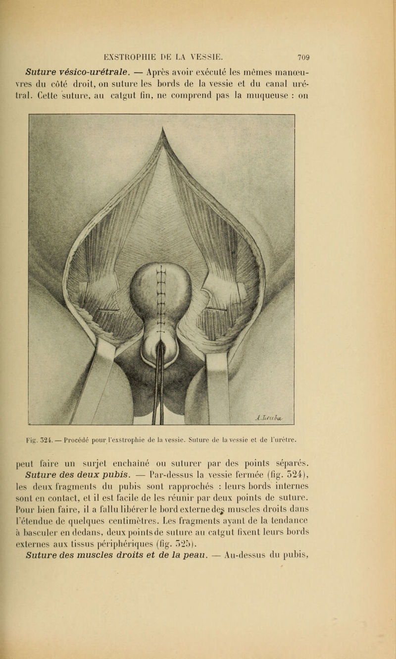 Suture vésico-urétrale. — Après avoir exécuté les mêmes manœu- vres du côté droit, on suture les bords de la vessie et du canal uré- tral. Cette suture, au catgut fin, ne comprend pas la muqueuse : on Fig. 324.— Procédé pour l'éxètrophie de la vessie. Suture de la vessie et de l'urètre. peut faire un surjet enchaîné ou suturer par des points séparés. Suture des deux pubis. — Par-dessus la vessie fermée (fig. 524), les deux fragments du pubis sont rapprochés : leurs bords internes sont en contact, et il est facile de les réunir par deux points de suture. Pour bien faire, il a fallu libérer le bord externe de^ muscles droits dans l'étendue de quelques centimètres. Les fragments ayant de la tendance à basculer en dedans, deuxpointsde suture au catgut fixent leurs bords externes aux tissus périphériques (fig. 7)L2b). Suture des muscles droits et de la peau. — Au-dessus du pubis,