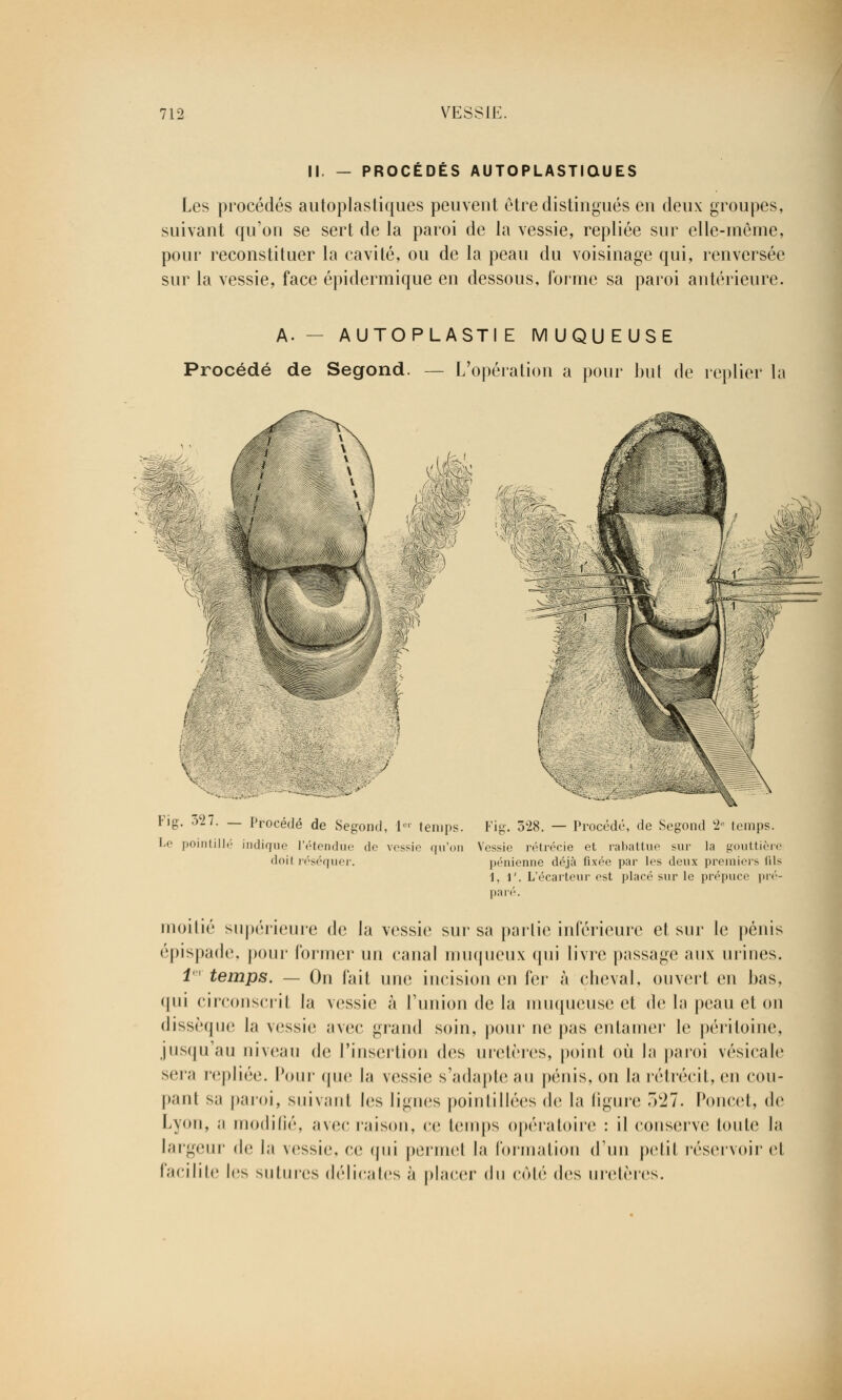 II. — PROCÉDÉS AUTOPLASTiaUES Les procédés autoplastiques peuvent être distingués en deux groupes, suivant qu'on se sert de la paroi de la vessie, repliée sur elle-même, pour reconstituer la cavité, ou de la peau du voisinage qui, renversée sur la vessie, face épidermique en dessous, l'orme sa paroi antérieure. A.— AUTOPLASTIE MUQUEUSE Procédé de Segond. — L'opération a pour but de replier la Fig. 327 Le pointi • — Procédé de Segond, 1- temps. lié indique l'étendue de vessie qu'on doit réséquer. ^•c Fig. 328. — Procédé, de Segond 2e temps. Vessie rétrécie et rabattue sur la gouttière pénienne déjà fixée par les deux premiers (ils 1, 1'. L'écarteur est placé sur le prépuce pré- paré. moitié supérieure de la vessie sur sa partie inférieure et sur le pénis épispade, pour former un canal muqueux qui livre passage4 aux urines. 1er temps. — On fait une incision en fer à cheval, ouvert eu bas, <|iii circonscrit la vessie à l'union de la muqueuse et de la peau et on dissèque la vessie avec grand soin, pour ne pas entamer le péritoine, jusqu au niveau de l'insertion dos uretères, point où la paroi vésicale sera repliée. Pour que la vessie s'adapte au pénis, on la rétrécit, en cou- pant sa paroi, suivant les lignes poinliliées de la ligure o^T. Poucet, de Lyon, a modifié, avec raison, ce temps opératoire : il conserve toute la largeur de la vessie, ce qui permel la formation d'un petil réservoir et facilite les sutures délicates à placer du côté des uretères.