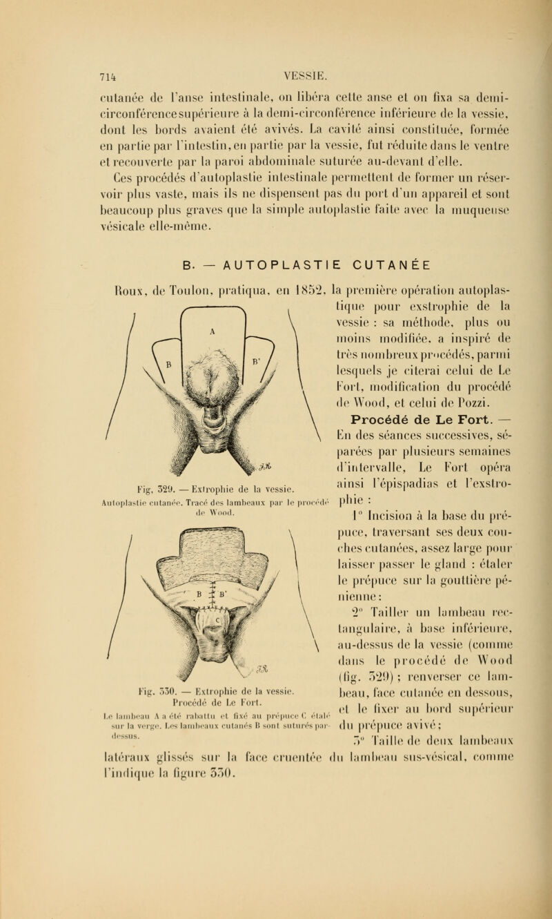 cutanée de l'anse intestinale, on libéra cette anse et on fixa sa demi- circonférence supérieure à la demi-circonférence inférieure de la vessie, dont les bords avaient été avivés. La cavité ainsi constituée, formée en partie par l'intestin, en partie par la vessie, fut réduite dans le ventre et recouverte par la paroi abdominale suturée au-devant d'elle. Ces procédés d'autoplastie intestinale permettent de former un réser- voir plus vaste, mais ils ne dispensent pas du port d'un appareil et sont beaucoup plus graves que la simple autoplastie faite avec la muqueuse vésicale elle-même. B. - AUTOPLASTIE CUTANÉE Roux, de Toulon, pratiqua, en 1852, la première opération autoplas- tique pour exstrophie de la vessie : sa méthode, plus ou moins modifiée, a inspiré de très nombreux procédés, parmi lesquels je citerai celui de Le Fort, modification du procédé de Wood, et celui de Pozzi. Procédé de Le Fort. — En des séances successives, sé- parées par plusieurs semaines d'intervalle, Le Fort opéra ainsi Fépispadias et l'exstro- \ phie : 1° Incision à la base du pré- puce, traversant ses deux cou- ches cutanées, assez large pour laisser passer le gland : étaler le prépuce sur la gouttière pé- nienne: w2 Ta il Ici* un lu m beau rec- tangulaire, à buse inférieure, au-dessus de la vessie (comme dans le procédé de Wood (fig. 329) ; renverser ce lam- beau, face cutanée en dessous, el le fixer au bord supérieur du prépuce avivé; 5° Taille de deux lambeaux du lambeau sus-vésical, comme Fig, 329. — Exlrophie de la vessie. Autoplasti cutanée. Tracé des lambeaux par le pro< de Wood. Fig. 530. — Extrophie de la vessie. Procédé de Le Fort. Le lambeau V a été rabattu et fixé au prépuce C étal sur la verge. Les lambeau* cutanés B sonl suturés pai dessus. latéraux glissés sur la face cruentée l'indique la figure 530.