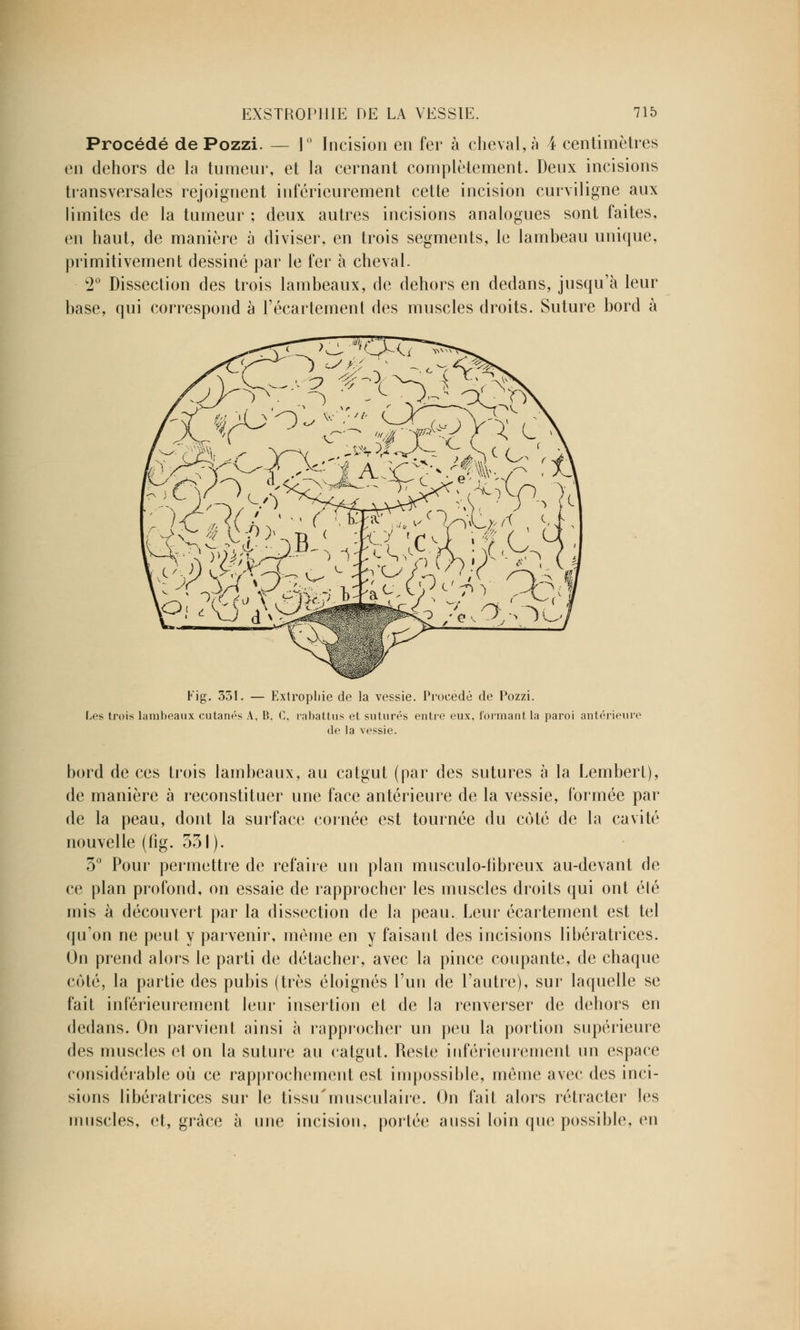 Procédé de Pozzi. — I Incision en fer à cheval, à 4 centimètres en dehors de la tumeur, et la cernant complètement. Deux incisions transversales rejoignent inférieurement cette incision curviligne aux limites de la tumeur ; deux autres incisions analogues sont faites, en haut, de manière à diviser, en trois segments, le lambeau unique, primitivement dessiné par le fer à cheval. c2° Dissection des trois lambeaux, de dehors en dedans, jusqu'à leur base, qui correspond à l'écartement des muscles droits. Suture bord à « t-Y %ju'rj #T_ c ^/ v- iS \v-r>> /X )B,1 Fig. 351. — Extropliie de la vessie. Procédé de Pozzi. Les trois lambeaux cutanés A, B. G. rabattus et suturés entre eux, formant la paroi antérieure de la vessie. bord de ces trois lambeaux, au catgut (par des sutures à la Lembert), de manière à reconstituer une face antérieure de la vessie, formée par de la peau, dont la surface cornée est tournée du coté de la cavité nouvelle (fig. 531). 3° Pour permettre de refaire un plan musculo-hbreux au-devant de ce plan profond, on essaie de rapprocher les muscles droits qui ont élé mis à découvert par la dissection de la peau. Leur écartement est tel qu'on ne peut y parvenir, même en y faisant des incisions libératrices. On prend alors le parti de détacher, avec la pince coupante, de chaque coté, la partie des pubis (très éloignés l'un de l'autre), sur laquelle se fait inférieurement leur insertion et de la renverser de dehors en dedans. On parvient ainsi à rapprocher un peu la portion supérieure des muscles et on la suture au catgut. Reste inférieurement un espace considérable où ce rapprochement est impossible, même avec des inci- sions libératrices sur le tissu'musculaire. On fait alors rétracter les muscles, et, grâce à une incision, portée aussi loin que possible, m