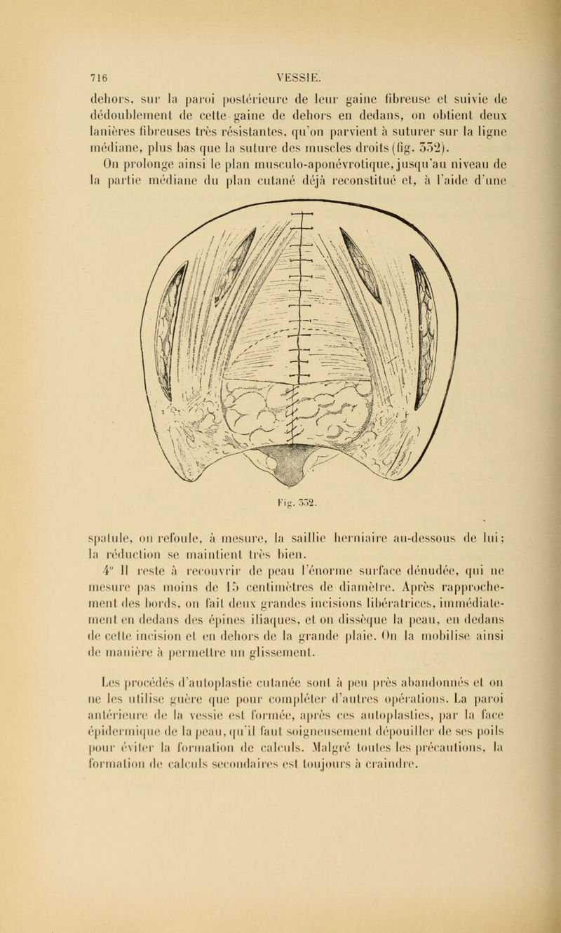dehors, sur la paroi postérieure de leur gaine fibreuse et suivie de dédoublement de cette gaine de dehors en dedans, on obtient deux lanières fibreuses très résistantes, qu'on parvient à suturer sur la ligne médiane, plus bas que la suture des muscles droits (fig. 332). On prolonge ainsi le plan musculo-aponévrotique, jusqu'au niveau de la partie médiane du plan cutané déjà reconstitué et, à l'aide d'une 332. spatule, ou refoule, à mesure, la saillie herniaire au-dessous de lui; la réduction se maintient très bien. 4° Il l'esté à recouvrir de peau l'énorme surface dénudée, qui ne mesure pas moins de 15 centimètres de diamètre. Après rapproche- ment des bords, on fait deux grandes incisions libératrices, immédiate- ment en dedans des épines iliaques, et on dissèque la peau, en dedans de celle incision el en dehors de la grande plaie. On la mobilise ainsi de manière à permettre un glissement. Les procédés d'autoplastie cutanée sonl à peu près abandonnés et on ne les utilise guère que pour compléter d'autres opérations. La paroi antérieure de la vessie est, formée, après ces autoplasties, par la face épidermique de la peau, qu'il faut soigneusemenl dépouiller de ses poils pour éviter la formation de ('aïeuls. Malgré toutes les précautions, la formation de calculs secondaires est toujours à craindre.