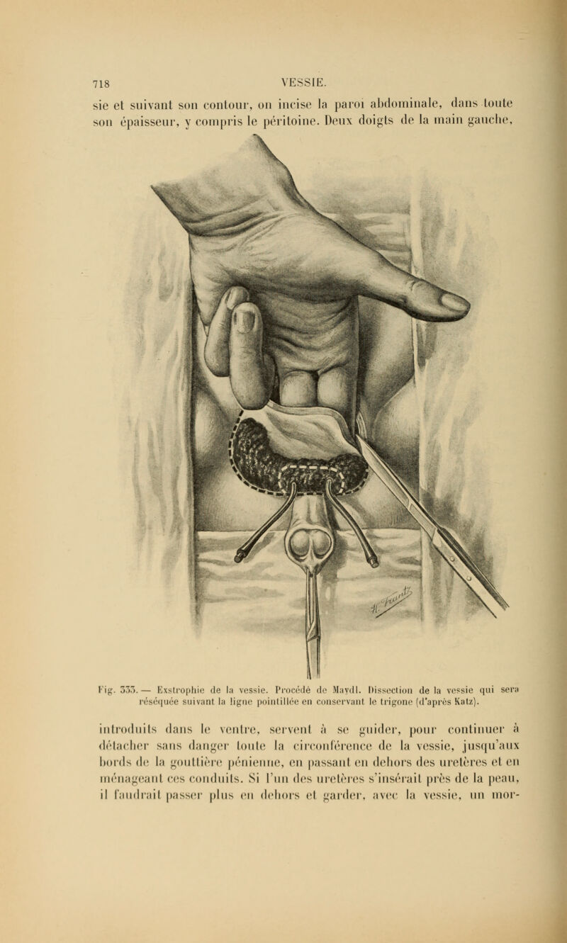 sie et suivant son contour, on incise la paroi abdominale, dans toute son épaisseur, y compris le péritoine. Deux doigts de la main gauche, \ X Fil 333.— Exstrophie de la vessie. Procédé de Maydl. Dissection delà vessie qui sen réséquée suivant la ligne pointillée en conservant le trigone (d'après Katz). introduits dans le ventre, servent à se guider, pour continuer à détacher sans danger toute la circonférence de la vessie, jusqu'aux bords de la gouttière pénienne, en passant en dehors des uretères cl en ménageant ces conduits. Si l'un des uretères s'insérait près de la peau, il faudrait passer plus en dehors el garder, avec la vessie, un inor-