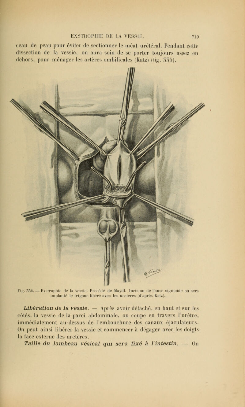 ceau de peau pour éviter de sectionner le méat urétéral. Pendant cette dissection de la vessie, on aura soin de se porter toujours assez en dehors, pour ménager les artères ombilicales (Katz) (fîg. 335). Fig. 334. Exstrophie de la vessie. Procédé de Maydl. Incision de l'anse sigmoïde où sera implanté le trigone libéré avec les uretères (d'après Katz). Libération de la vessie. — Après avoir détaché, en haut et sur les côtés, la vessie de la paroi abdominale, on coupe en travers l'urètre, immédiatement au-dessus de l'embouchure des canaux éjaculateurs. On peut ainsi libérer la vessie el commencer à dégager avec les doigts la face externe des uretères. Taille du lambeau vésical qui sera fixé à l'intestin. — On