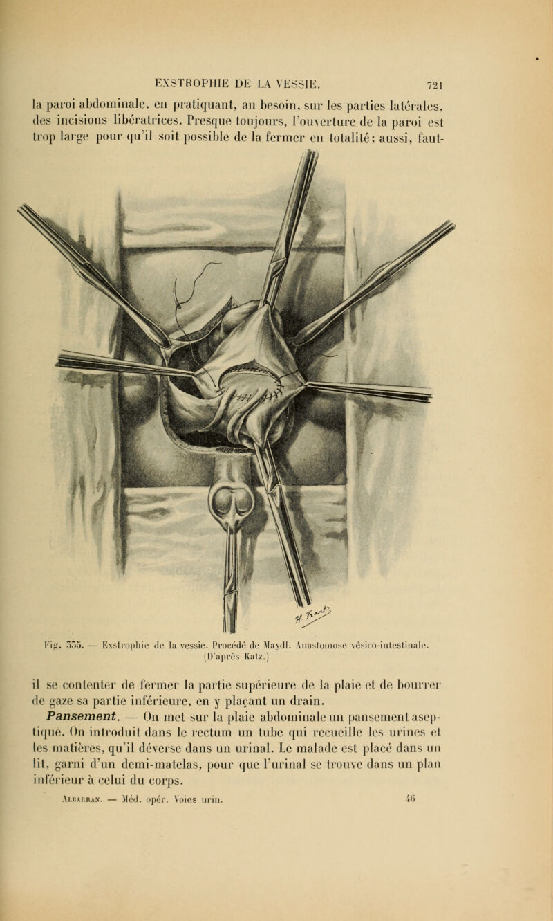 la paroi abdominale, en pratiquant, au besoin, sur les parties latérales, des incisions libératrices. Presque toujours, l'ouverture de la paroi est trop large pour qu'il soit possible de la fermer en totalité; aussi, faut- Fig. Ô55. — Exstrophie de la vessie. Procédé de Maydl. Anastomose vésico-intestinale. (D'après Katz.) il se contenter de fermer la partie supérieure de la plaie et de bourrer de gaze sa partie inférieure, en y plaçant un drain. Pansement. — On met sur la plaie abdominale un pansement asep- tique. On introduit dans le rectum un tube qui recueille les urines et les matières, qu'il déverse dans un urinai. Le malade est placé dans un lit, garni d'un demi-matelas, pour que l'urinai se trouve dans un plan inférieur à celui du corps. Albarran. — Méd. opér. Voies urin. 40