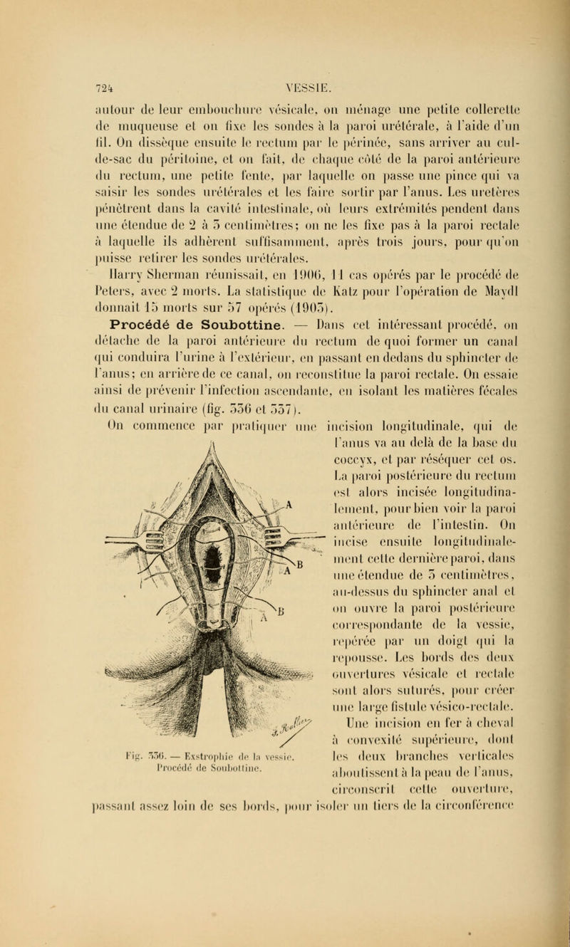 autour de leur embouchure vésicale, ou ménage une petile collerette de muqueuse et on fixe les sondes à la paroi urétérale, à laide d'un fil. On dissèque ensuite le rectum par le périnée, sans arriver au cul- de-sac du péritoine, et on l'ait, de chaque côté de la paroi antérieure du rectum, une petite t'ente, par laquelle on passe une pince qui va saisir les sondes urétérales et les faire sortir par l'anus. Les uretères pénètrent dans la cavité intestinale, où leurs extrémités pendent dans une étendue de c2 à 5 centimètres; on ne les fixe pas à la paroi rectale à laquelle ils adhèrent suffisamment, après trois jours, pour qu'on puisse retirer les sondes urétérales. llarry Sherman réunissait, en 1906, 11 cas opérés par le procédé de Peters, avec 2 morts. La statistique de Katz pour l'opération de Maydl donnait 15 morts sur 57 opérés (1905). Procédé de Soubottine. — Dans cet intéressant procédé, on détache de la paroi antérieure du rectum de quoi former un canal qui conduira l'urine à l'extérieur, en passant en dedans du sphincter de l'anus; en arrière de ce canal, on reconstitue la paroi rectale. On essaie ainsi de prévenir l'infection ascendante, en isolant les matières fécales du canal urinaire (fig. 536 et 557). On commence par pratiquer une incision longitudinale, qui de Ta nus va au delà de la base du coccyx, et par réséquer cet os. La paroi postérieure du rectum esl alors incisée longitudina- Iement, pour bien voir la paroi antérieure de l'intestin. On incise ensuite longitudinale- ment cette dernière paroi, dans une étendue de 5 centimètres, au-dessus du sphincter anal et on ouvre la paroi postérieure correspondante de la vessie, repérée par un doigt qui la repousse. Les bords des deux ouvertures vésicale et rectale sont alors suturés, pour créer une large fistule vésico-rectale. Une incision en fer à cheval à convexité supérieure, dont les deux branches verticales aboutissent à la peau de l'anus, circonscrit celte ouverture, soler un tiers de la circonférence Fig. ..(). — Exstrophie de la vessie Procédé do Soubottine. passanl assez loin de ses bords, pour i