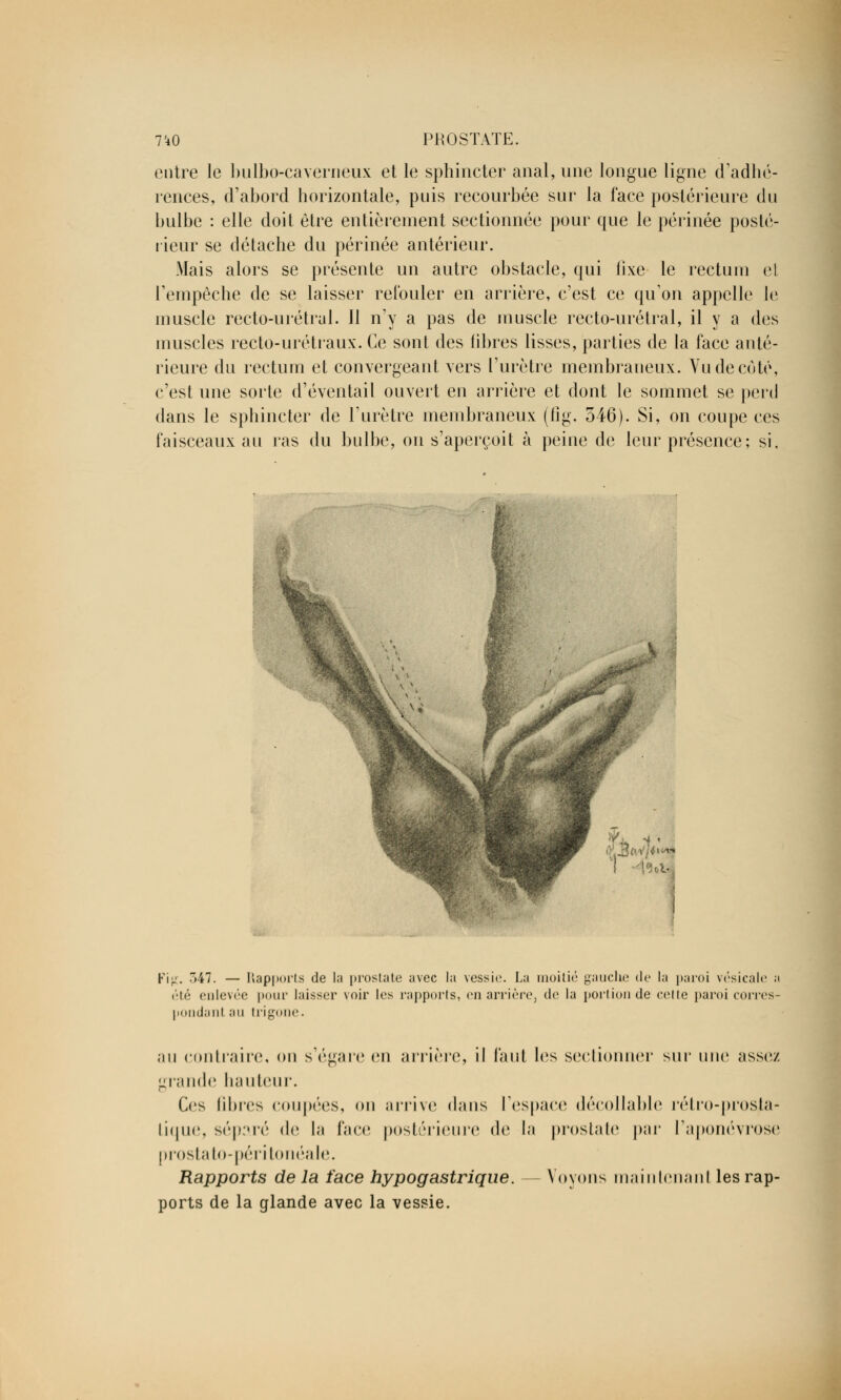 entre le bulbo-caverneux et le sphincter anal, une longue ligne d'adhé- rences, d'abord horizontale, puis recourbée sur la face postérieure du bulbe : elle doit être entièrement sectionnée pour que le périnée posté- rieur se détache du périnée antérieur. Mais alors se présente un autre obstacle, qui fixe le rectum et l'empêche de se laisser refouler en arrière, c'est ce qu'on appelle le muscle recto-urétral. Jl n'y a pas de muscle recto-urétral, il y a des muscles recto-urétraux. Ce sont des fibres lisses, parties de la face anté- rieure du rectum et convergeant vers l'urètre membraneux. Vu de coté, c'est une sorte d'éventail ouvert en arrière et dont le sommet se perd dans le sphincter de l'urètre membraneux (fig. 546). Si, on coupe ces faisceaux au ras du bulbe, on s'aperçoit à peine de leur présence; si. Kij;. 347. — Rapports de la prostate avec la vessie. La moitié gauche de la paroi vésicàle : été enlevée pour laisser voir les rapports, en arrière, de la portion de colle paroi corres pondant an trigone. an contraire, on s'égare en arrière, il faut les sectionner sur une assez grande hauteur. Ces fibres coupées, on arrive dans l'espace décollable rétro-prosjta- Lique, séparé de la face postérieure de la prostate par l'aponévrose prostato-péritonéale. Rapports de la face hypogastrique. Voyons maintenanl les rap- ports de la glande avec la vessie.