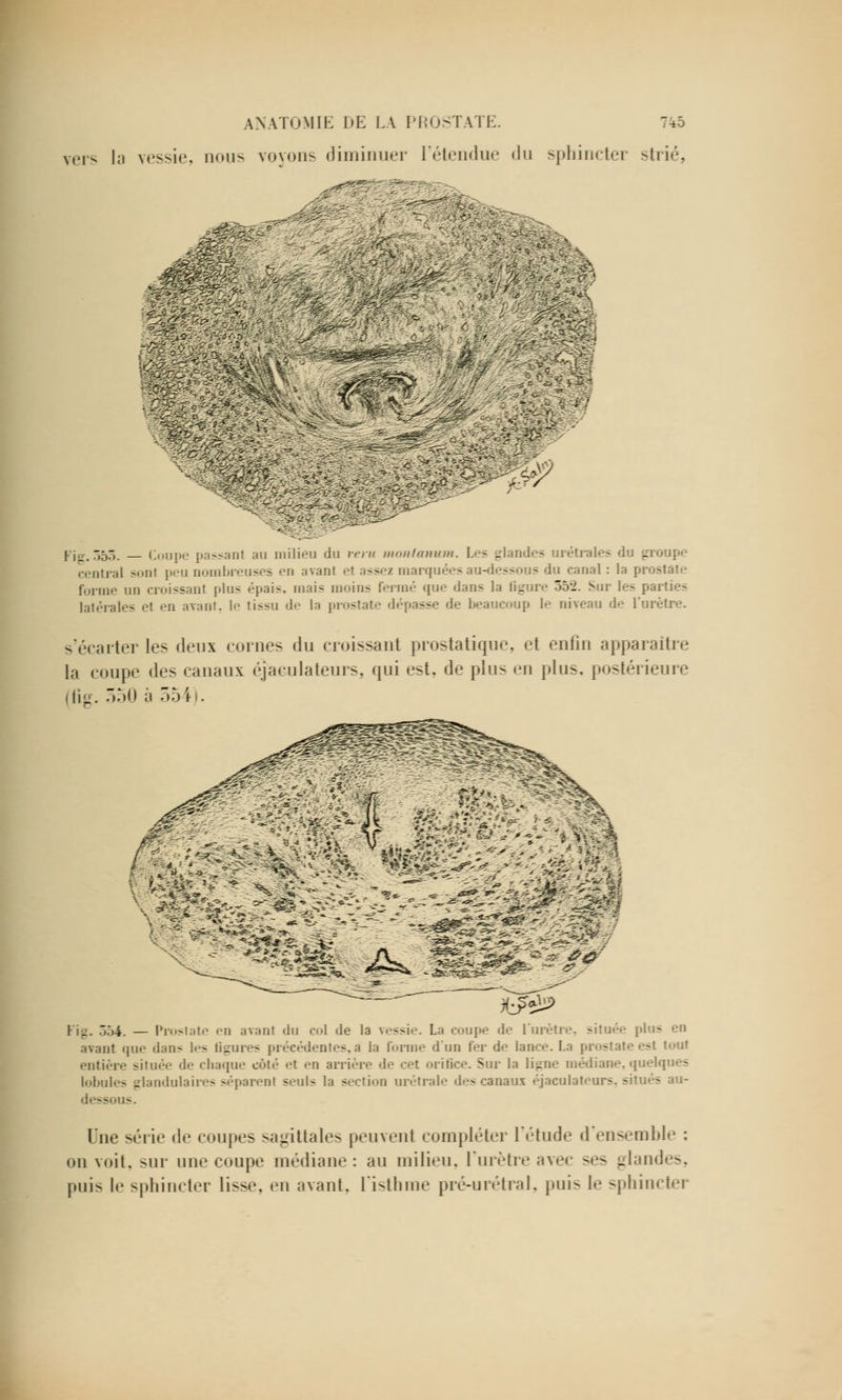 vers la vessie, nous voyons diminuer l'étendue du sphincter strié, •^ & I „ 553, _ Coupe passaol au milieu du reru montanum. Les glandes urétrales du groupe central sonl peu nombreuses en avant el assez marquées au-dessous du canal : la prostate forme un croissant plus épais, mais moins fermé que dans la ligure ô5'2. Sur les parties latérales et en avant, le tissu de la prostate dépasse de beaucoup le niveau de l'urètre. s'écarter les deux eûmes du croissant prostatique, et enfin apparaître la coupe des canaux éjaeulateurs, qui est. de plus en plus, postérieure (fig. 350 ii 354). WÊÈ^^M£>ÊëM, ^^^, **4ÈBt*<£&-*J^~ -*-- — ^•^-^-~^r^- r^i^k *J*^> ] i_. 554, — Prostate en avant du col de la Tessîe. La coupe de l'urètre, située p - avant que dan- les ligures précédentes,à la forme d'un fer de lance. La prostate est tout entière située de chaque côté et en arrière de cet orifice. Sur la ligne médiane, quelques lobules glandulaires séparent seuls la section urétrale des canaux éjaculateurs, situés dessous. lue série de coupes sagittales peuvent compléter l'étude d'ensemble : ou voit, sur une coupe médiane: au milieu, l'urètre avec ses glandes, puis le sphincter lisse, en avant, l'isthme pré-urétral, puis le sphincter