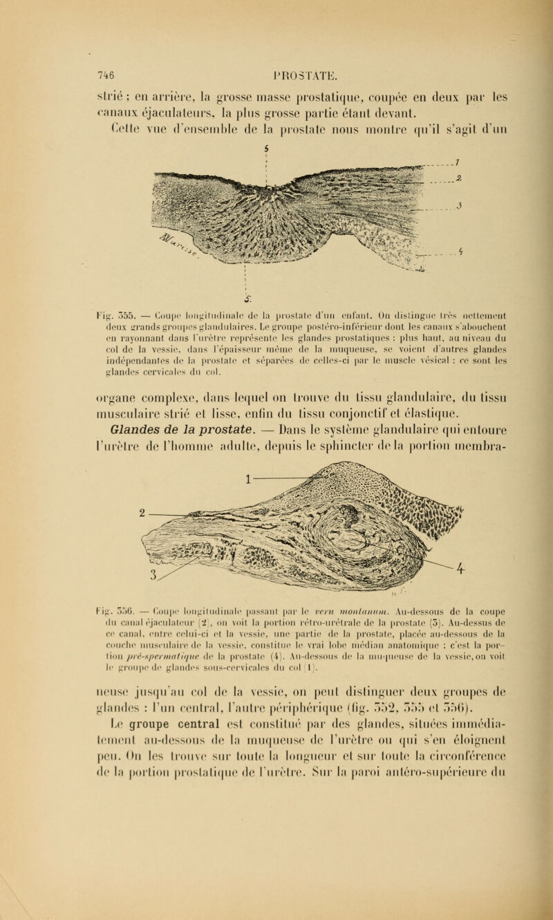 strié ; en arrière, la grosse masse prostatique, coupée en deux par les canaux éjaculateurs, la plus grosse partie étant devant. Cette vue d'ensemble de la prostate nous montre qu'il s'agit d'un ..4 ■--.-«£ Fig. 555. — Coupe longitudinale de la prostate d'un enfant. On distingue 1res nettement deux grands groupes glandulaires. Le groupe postéro-inférieur dont les canaux s'abouchent en rayonnant dans l'urètre représente les glandes prostatiques : plus haut, au niveau du col de la vessie, dans l'épaisseur même de la muqueuse, se voient d'autres glandes indépendantes de la prostate et séparées de celles-ci par le muscle vésical : ce sont les glandes cervicales du col. organe complexe, dans lequel on trouve du tissu glandulaire, du tissu musculaire strié et lisse, enfin du tissu conjonctif et élastique. Glandes de la prostate. — Dans le système glandulaire qui entoure l'urètre de l'homme adulte, depuis le sphincter delà portion mcmhra- s^gpî$£^3<-; - m™ Fig. 356. — Coupe longitudinale passant par le veru montanum. Au-dessous de la coupe du canaléjaculateur [1), on voit la portion rétro-urétrale de la prostate (5). Au-dessus de ce canal, entre celui-ci et la vessie, une partie de la prostate, placée au-dessous de la couche musculaire de la vessie, constitue le vrai lobe médian anatomique : c'est la por lion pré-spermatique de la prostate (4). Au-dessous de la muqueuse dé la vessie,on voit le groupe de glandes sous-cervicales du col 1). neuse jusqu'au col de la vessie, on peut distinguer deux groupes de glandes : l'un central, l'autre périphérique (fig. 352, 355 el 556). Le groupe central est constitué par des glandes, situées immédia- tement au-dessous de la muqueuse de l'urètre ou qui s'en éloignent peu. On les trouve sur loule In longueur et sur toute la circonférence de la portion prostatique de l'urètre. Sur la paroi antéro-supérieure du