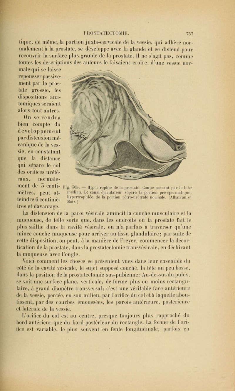 l k -m- ■ tique, de même, la portion juxta-cervicale de Ja vessie, qui adhère nor- malement à la prostate, se développe avec la glande et se distend pour recouvrir la surface plus grande de la prostate. 11 ne s'agit pas, comme toutes les descriptions des auteurs le faisaient croire, d'une vessie nor- male qui se laisse - - repousser passive- ment par la pros- tate grossie, les dispositions ana- tomiques seraient alors tout autres. On se rendra bien compte du développement par distension mé- canique de la ves- sie, en constatant que la distance qui sépare le col des orifices urété- raux, normale- ment de 5 centi- mèlres, peut at- teindre 6 centimè- tres et davantage. La distension de la paroi vésicale amincit la couche musculaire et la muqueuse, de telle sorte que, dans les endroits où la prostate fait le plus saillie dans la cavité vésicale, on n'a parfois à traverser qu'une mince couche muqueuse pour arriver au tissu glandulaire ; par suite de cette disposition, on peut, à la manière de Freyer, commencer la décor- tication de la prostate, dans la prostatectomie trausvésicale, en déchirant la muqueuse avec l'ongle. Voici comment les choses se présentent vues dans leur ensemble du coté de la cavité vésicale, le sujet supposé couché, la tète un peu basse, dans la position de la prostatectomie sus-pubienne : Au-dessus du pubis, se voit une surface plane, verticale, de forme plus ou moins rectangu- laire, à grand diamètre transversal; c'est une véritable face antérieure de la vessie, percée, en son milieu, par l'orifice du col et à laquelle abou- tissent, par des courbes émoussées, les parois antérieure, postérieure et latérale de la vessie. L'orifice du col est au centre, presque toujours plus rapproché du bord antérieur que du bord postérieur du rectangle. La forme de l'ori- fice est variable, le plus souvent en fente longitudinale, parfois en g. 565. — Hypertrophie de la prostate. Coupe passant par le lobe médian. Le canal éjaculateur sépare la portion pré-spermatique, hypertrophiée, de la portion rétro-urétrale normale. (Alharran cl Motz.l