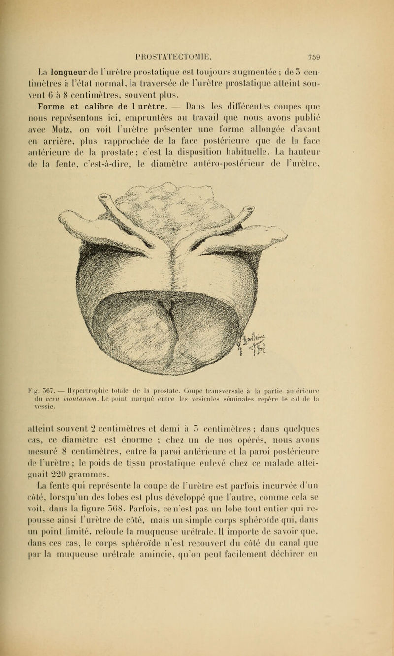 La longueur de l'urètre prostatique est toujours augmentée ; de 5 cen- timètres à l'état normal, la traversée de l'urètre prostatique atteint sou- vent 6 à 8 centimètres, souvent plus. Forme et calibre de 1 urètre. — Dans les différentes coupes que nous représentons ici, empruntées au travail que nous avons publié avec Motz, on voit l'urètre présenter une forme allongée d'avant en arrière, plus rapprochée de la face postérieure que de la face antérieure de la prostate; c'est la disposition habituelle. La hauteur de la fente, c'est-à-dire, le diamètre antéro-postérieur de l'urètre, Fi g. 567.— Hypertrophie totale de la prostate. Coupe transversale à la partie antérieure du veru montanum. Le point marqué entre les vésicules séminales repère le col de la vessie. atteint souvent 2 centimètres et demi à ô centimètres ; dans quelques ras, ce diamètre est énorme ; chez un de nos opérés, nous avons mesuré 8 centimètres, entre la paroi antérieure et la paroi postérieure de l'urètre; le poids de tissu prostatique enlevé chez ce malade attei- gnait '220 grammes. La fente qui représente la coupe de l'urètre est parfois incurvée d'un côté, lorsqu'un des lobes est plus développé que l'autre, comme cela se voit, dans la figure 568. Parfois, ce n'est pas un lobe tout entier qui re- pousse ainsi l'urètre de côté, mais un simple corps sphéroïde qui, dans un point limité, refoule la muqueuse urétrale. Il importe de savoir que, dans ces cas, le corps sphéroïde n'est recouvert du côté du canal que par la muqueuse urétrale amincie, qu'on peut facilement déchirer en