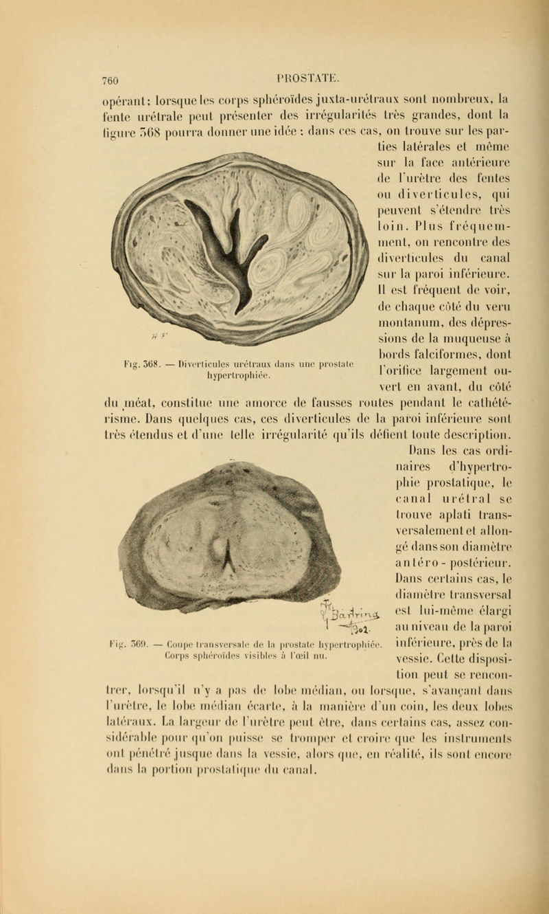 Fis. 3(38, Diverticules urétraux dans une prostate hypertrophiée. 760 PROSTATE. opérant; lorsque les corps sphéroïdes juxta-urétraux sonl nombreux, la fente urétrale peut présenter des irrégularités très grandes, dont la figure 568 pourra donner une idée : dans ces cas, on trouve sur les par- ties latérales et môme sur la face antérieure de l'urètre des fentes ou diverticules, qui peuvent s'étendre très loin. Plus fréquem- ment, on rencontre des diverticules du canal sur la paroi inférieure. Il est fréquent de voir, de chaque côté du veru montanum, des dépres- sions de la muqueuse à bords falciformes, dont l'orifice largement ou- vert en avant, du côté du méat, constitue une amorce de fausses routes pendant le cathété- risme. Dans quelques cas, ces diverticules de la paroi inférieure sont très étendus et d'une telle irrégularité qu'ils défient toute description. Dans les cas ordi- naires d'hypertro- phie prostatique, le canal u r é t r a 1 se trouve aplati trans- versalement et allon- gé dans son diamètre antéro- postérieur. Dans certains cas, le diamètre transversal est lui-même élargi au niveau de la paroi inférieure, près de la vessie. Celte disposi- tion peut se rencon- trer, lorsqu'il n'y a pas de lobe médian, ou lorsque, s'avançanl dans l'urètre, le lobe, médian écarte, à la manière d'un coin, les deux lobes latéraux. La largeur de l'urètre peut être, dans certains cas, assez con- sidérable pour qu'on puisse se tromper et croire que les instruments oui pénétré jusque dans la vessie, alors que, en réalité, ils soûl encore dans la portion prostatique du canal. 560. — Coupe transversale de la prostate hypertrophiée. Corps sphéroïdes visibles ;'i l'œil nu.