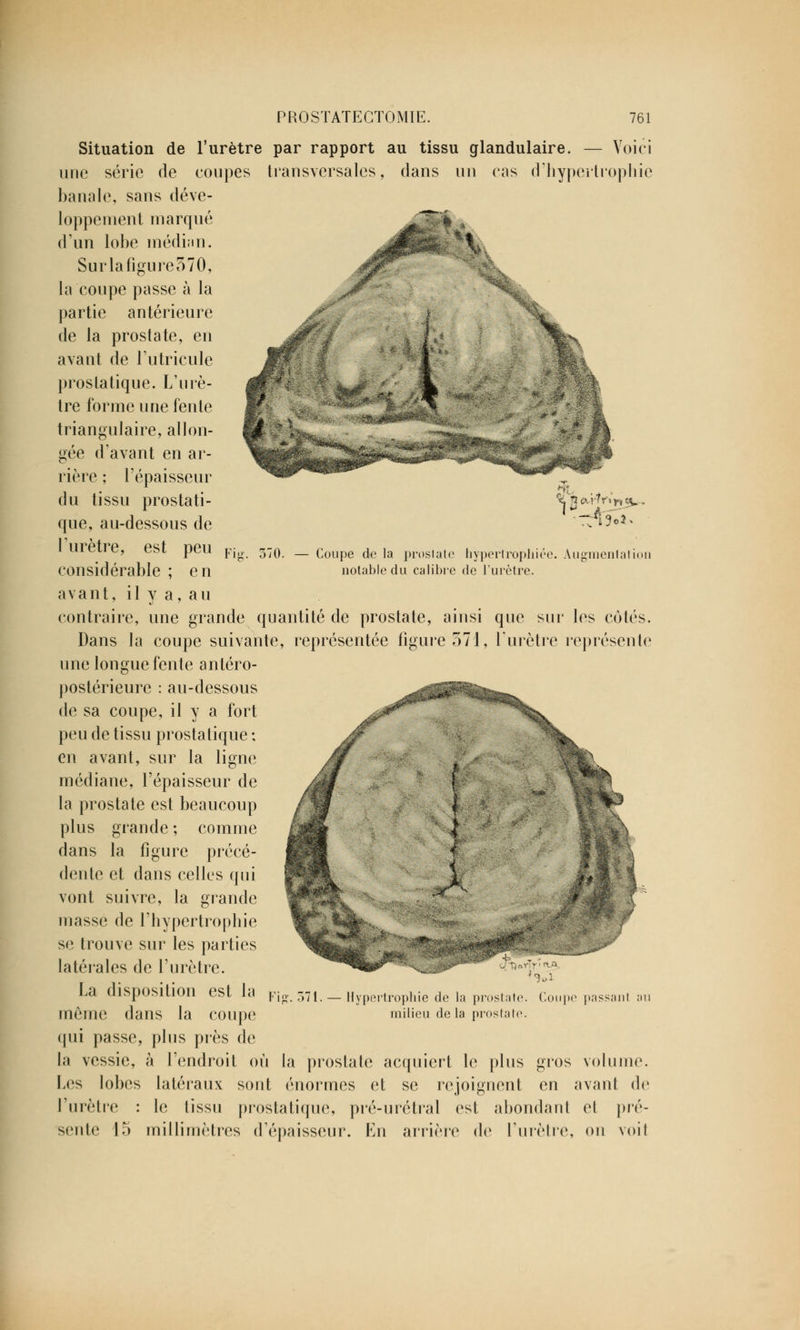 - Voici trophie 1 « » rlr, *•»«- si3o2 70. — Coupe de la proslate hypertrophiée. Augmentât ion notable du calibre de l'urètre. Situation de l'urètre par rapport au tissu glandulaire, une série de coupes transversales, dans un cas d'hypc banale, sans déve- loppement marqué d'un lobe médian. Surlafigure570, la coupe passe à la partie antérieure de la prostate, en avant de l'utricule prostatique. L'urè- tre forme une fente triangulaire, allon- gée d'avant en ar- rière ; l'épaisseur du tissu prostati- que, au-dessous de l'urètre, est peu considérable ; en avant, il y a, au contraire, une grande quantité de prostate, ainsi que sur les cotés. Dans la coupe suivante, représentée figure 571, l'urètre représente une longue fente antéro- postérieure : au-dessous de sa coupe, il y a fort peu de tissu prostatique ; en avant, sur la ligne médiane, l'épaisseur de la prostate est beaucoup plus grande; comme dans la figure précé- dente et dans celles qui vont suivre, la grande masse de l'hypertrophie se trouve sur les parties latérales de l'urètre. La disposition est la môme dans la coupe qui passe, plus près de la vessie, à l'endroit où la prostate acquiert le plus gros volume. Les lobes latéraux sont énormes et se rejoignent en avant de l'urètre : le tissu prostatique, pré-urétral est abondant et pré- sente 15 millimètres d'épaisseur. En arrière de l'urètre, on voil Hypertrophie de la prostate milieu de la prostate Coupe passant au