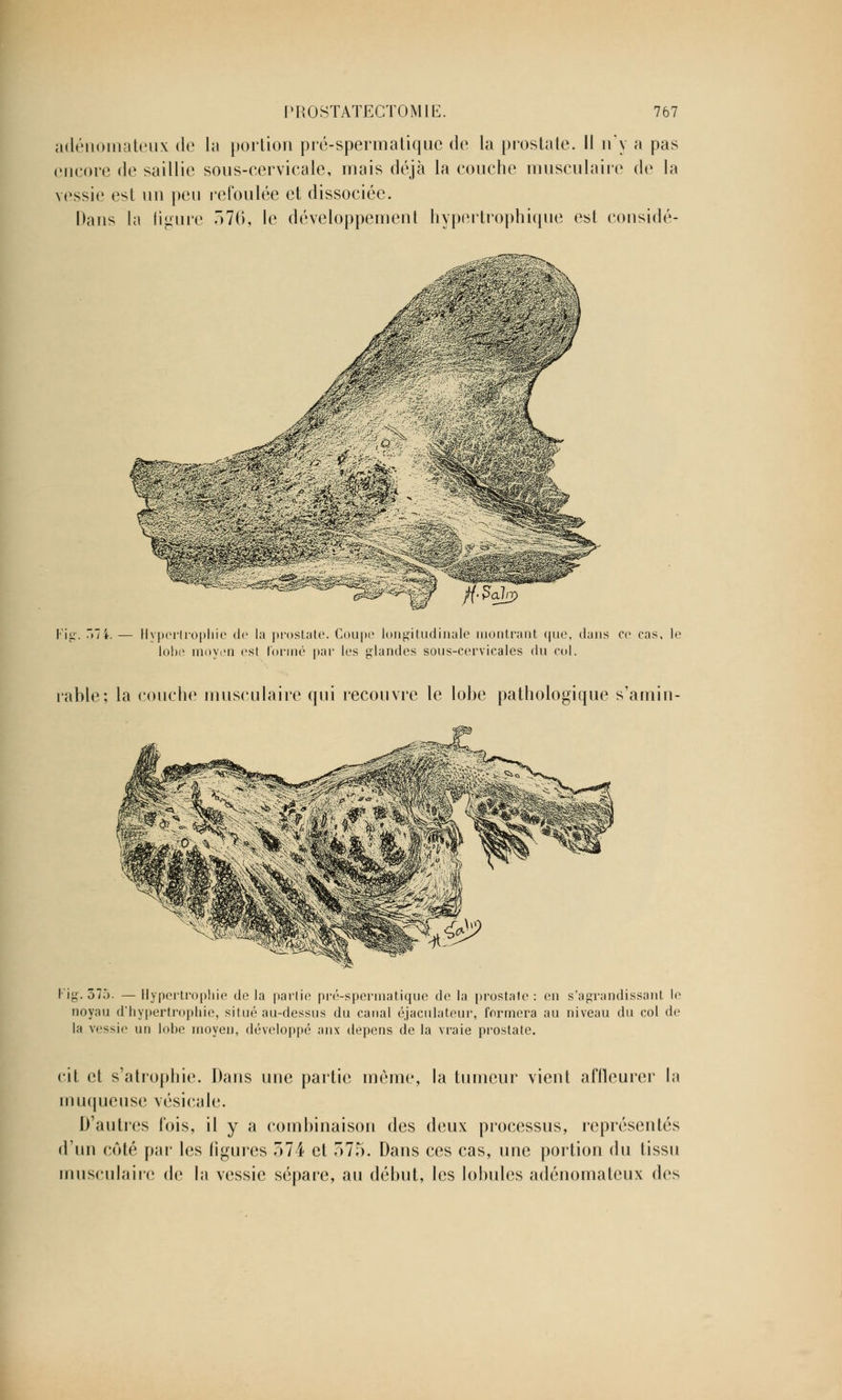 adénomateux de la portion pré-spermatiquc de la prostate. Il n'y a pas encore de saillie sous-cervicale, mais déjà la couche musculaire de la vessie est un peu refoulée et dissociée. Dans la figure 576, le développement hypertrophique est considé- Fig. .7 4. — Hypertrophie de la prostate. Coupe longitudinale montrant que, dans ce cas, le lobe moyen est l'orme par les glandes sous-cervicales du col. table; la couche musculaire qui recouvre le lobe pathologique s'amin- Fig. 375. — Hypertrophie de la partie pré-spermatiquc de la prostate: en s'agrandissant le noyau d'hypertrophie, situé au-dessus du canal éjaculateur, formera au niveau du col de la vessie un lobe moyen, développé anx dépens de la vraie prostate. cit et s'atrophie. Dans une partie même, la tumeur vient affleurer ht muqueuse vésicale. D'autres fois, il y a combinaison des deux processus, représentés d'un côté par les ligures 574 et 575. Dans ces cas, une portion du tissu musculaire de la vessie sépare, au début, les lobules adénomateux des