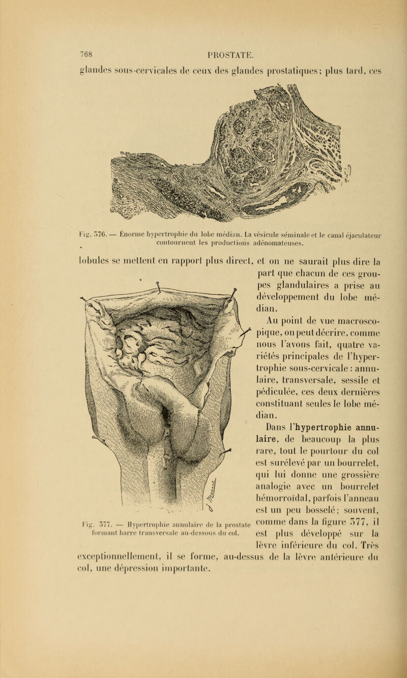 glandes sous-cervicales de ceux des glandes prostatiques; plus tard, ces '.70. ^^^ Énorme hypertrophie du lobe médian. La vésicule séminale et le canal éjaculateur contournent les productions adénomateuses. lobules se mettent en rapport plus direct, et on ne saurait plus dire la part que chacun de ces grou- pes glandulaires a prise au développement du lobe mé- dian. Au point de vue macrosco- pique, on peut décrire, comme nous l'avons fait, quatre va- riétés principales de l'hyper- trophie sous-cervicale : annu- laire, transversale, sessile et pédiculée, ces deux dernières constituant seules le lobe mé- dian. Dans l'hypertrophie annu- laire, de beaucoup la plus rare, tout le pourtour du col est surélevé par un bourrelet, qui lui donne une grossière analogie avec un bourrelet hémorroïdal, parfois l'anneau ;st un peu bosselé; souvent, comme dans la figure 577, il est plus développé sur la lèvre inférieure du col, Très au-dessus de la lèvre antérieure du :. 377. — Hypertrophie annulaire de la prostate formanl barre transversale au-dessous du col. exceptionnellement, il se forme col, une dépression importante.