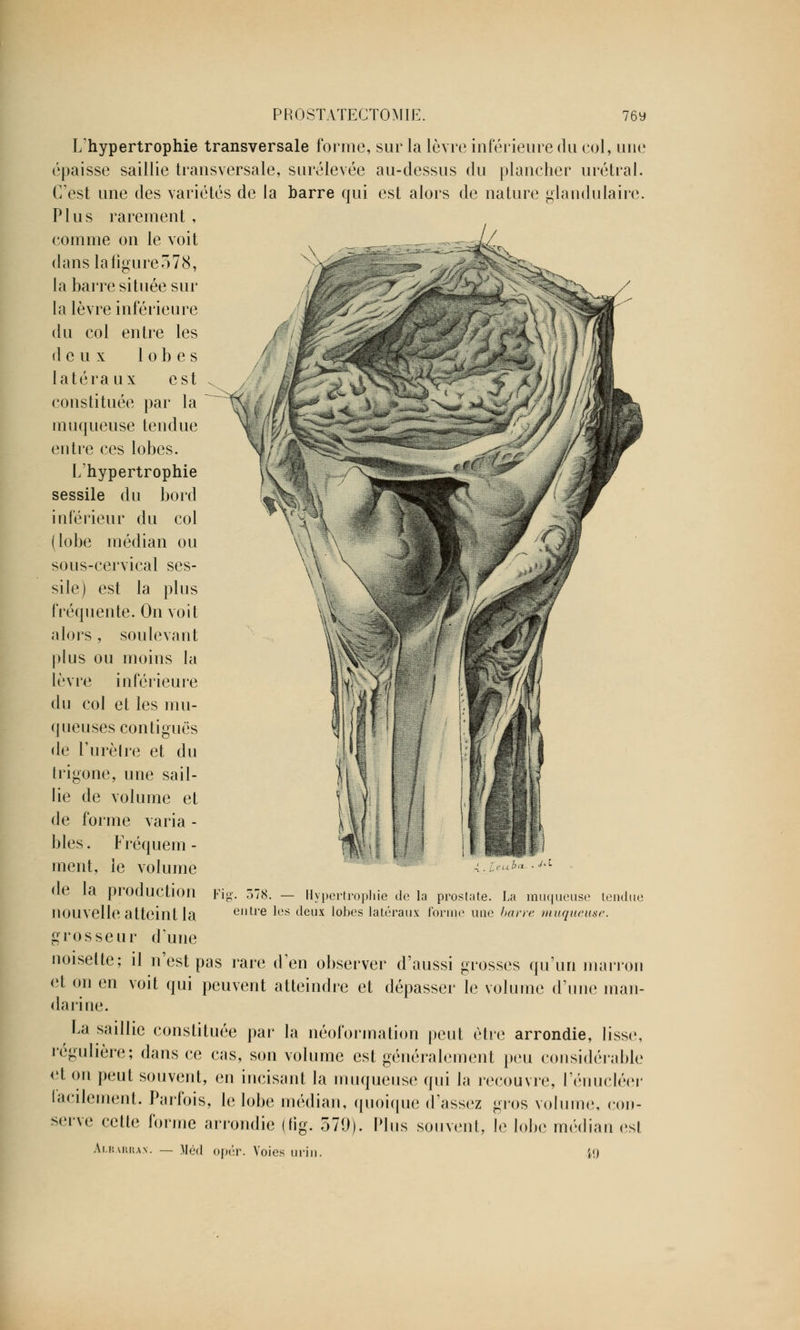 L'hypertrophie transversale forme, sur la lèvre inférieure du col, une épaisse saillie transversale, surélevée au-dessus du plancher urétrai. C'est une des variétés de la barre qui est alors de nature glandulaire. Plus rarement , comme on le voit dans la figure 578, la barre située sur la lèvre inférieure du col entre les deux lobes latéraux est constituée par la muqueuse tendue entre ces lobes. L'hypertrophie sessile du bord inférieur du col (lobe médian ou sous-cervical ses- sile) est la plus fréquente. On voit alors , soulevant plus ou moins la lèvre inférieure du col et les mu- queuses contiguës de l'urèlre et du trigone, une sail- lie de volume et de forme varia - blés. Fréquem - ment, le volume de la production nouvelle atteint la grosseur dune noisette; il n'est pas rare d'en observer d'aussi grosses qu'un marron et on en voit qui peuvent atteindre et dépasser le volume d'une man- darine. La saillie constituée par la néoformation peut être arrondie, lisse, régulière; dans ce cas, son volume est généralement peu considérable et on peut souvent, en incisant la muqueuse qui la recouvre, l'énucléer lacilement. Parfois, le lobe médian, quoique «Tassez gros volume, con- serve cette forme arrondie (fîg. 579). Plus souvent, le lobe médian est Fig. 578. — Hypertrophie de la prostate. La muqueuse tendue entre les deux lobes latéraux forme une barre muqueuse. Albarrax. — Méd opér. Voies min iO