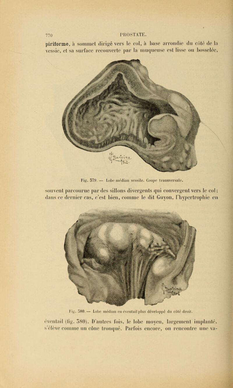 piriforme, à sommet dirigé vers le col, à base arrondie du coté de la vessie, et sa surface recouverte par la muqueuse est lisse ou bosselée. Fiff. 379. v-isi Lobe médian sessile. Coupe transversale. souvent parcourue par des sillons divergents qui convergent vers le col; dans ce dernier cas, c'est bien, comme le dit Guyon, l'hypertrophie en Fig. .80.— Lobe médian en éventail plus développé du côté droit. éventail (fig. 580). D'autres lois, le lobe moyen, largemenl implanté, s élève comme un cône tronqué. Parfois encore, on rencontre une va