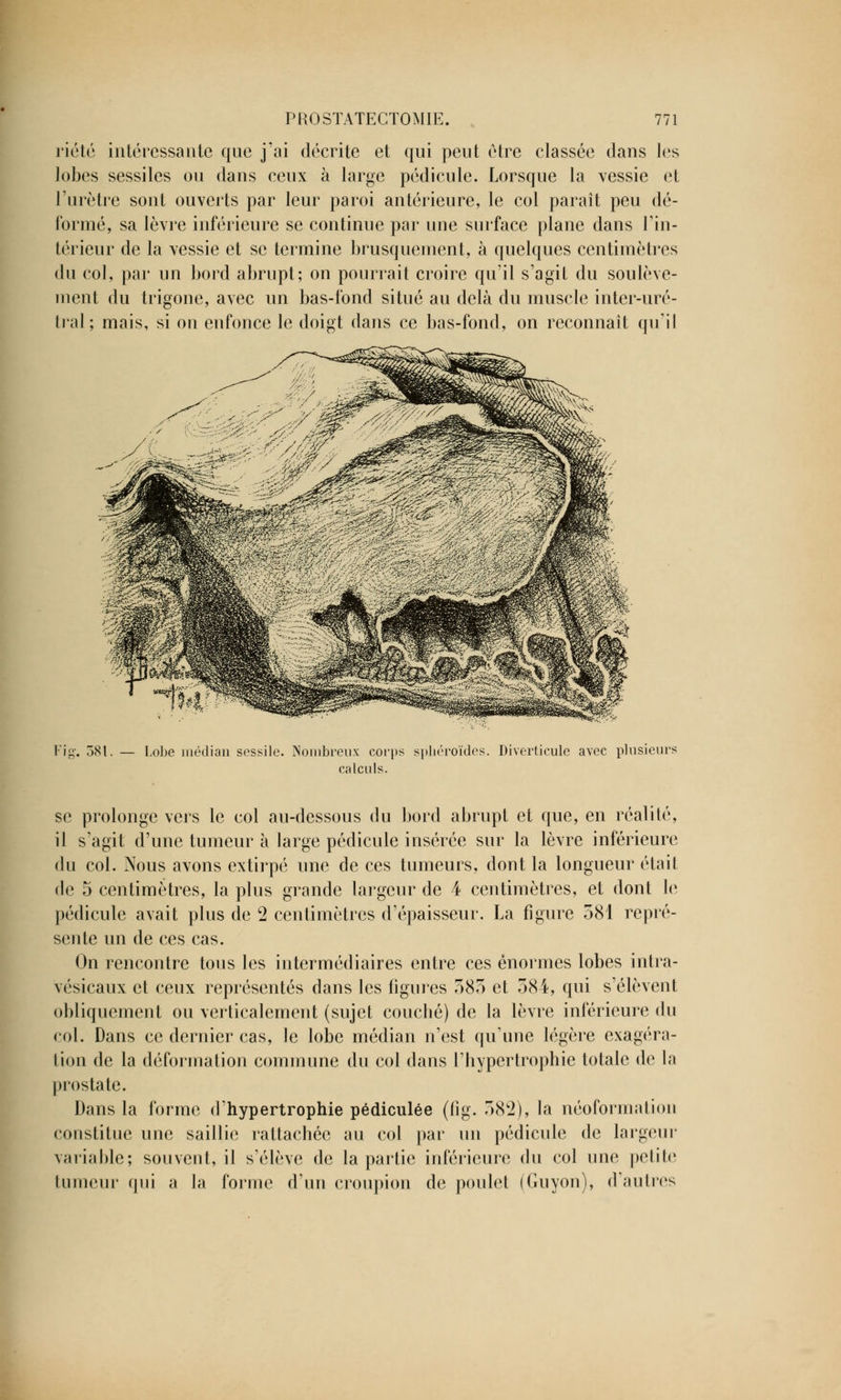 riété intéressante que j'ai décrite et qui peut être classée dans les lobes sessiles ou dans ceux à large pédicule. Lorsque la vessie et l'urètre sont ouverts par leur paroi antérieure, le col paraît peu dé- formé, sa lèvre inférieure se continue par une surface plane dans l'in- térieur de la vessie et se termine brusquement, à quelques centimètres du col, par un bord abrupt; on pourrait croire qu'il s'agit du soulève- ment du trigone, avec un bas-fond situé au delà du muscle inter-uré- tral; mais, si on enfonce le doigt dans ce bas-fond, on reconnaît qu'il Fig. 581 Lobe médian sessile. Nombreux corps sphéroïdes. Drverticule avec plusieurs calculs. se prolonge vers le col au-dessous du bord abrupt et que, en réalité, il s'agit d'une tumeur à large pédicule insérée sur la lèvre inférieure du col. Nous avons extirpé une de ces tumeurs, dont la longueur était de 5 centimètres, la plus grande largeur de 4 centimètres, et dont le pédicule avait plus de 2 centimètres d'épaisseur. La figure 581 repré- sente un de ces cas. On rencontre tous les intermédiaires entre ces énormes lobes intra- vésicaux et ceux représentés dans les figures 585 et 584, qui s'élèvent obliquement ou verticalement (sujet couché) de la lèvre inférieure du col. Dans ce dernier cas, le lobe médian n'est qu'une légère exagéra- tion de la déformation commune du col dans l'hypertrophie totale de la prostate. Dans la forme d'hypertrophie pédiculée (fîg. 582), la néoformation constitue une saillie rattachée au col par un pédicule de largeur variable; souvent, il s'élève de la partie inférieure du col une petite tumeur qui a la forme d'un croupion de poulet (Guyon), d'autres