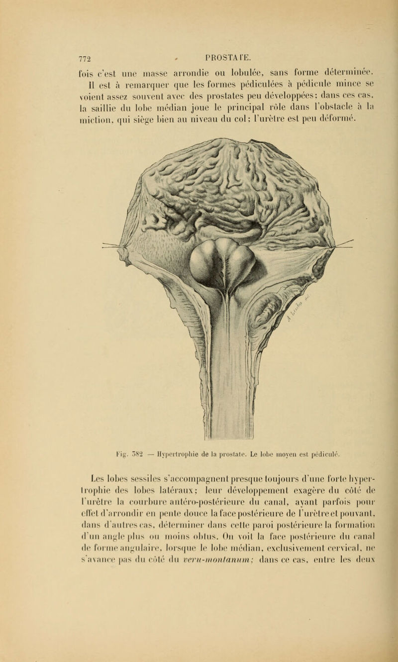 fois c'est une masse arrondie ou lobulée, sans forme déterminée. Il est à remarquer que les formes pédiculées à pédicule mince se voient assez souvent avec des prostates peu développées; dans ces cas. la saillie du lobe médian joue le principal rôle dans l'obstacle à la miction, qui siège bien au niveau du col; l'urètre est peu déformé. Fig. 382 — Hypertrophie de la prostate. Le lobe moyen est. pédicule''. Les lobes sessiles s'accompagneni presque toujours d'une forte hyper- trophie des lobes latéraux; leur développement exagère du côté de l'urètre la courbure antéro-postérieure du canal, ayant parfois pour effet d'arrondir en pente douce la face postérieure de l'urètre et pouvant, dans d'autres cas, déterminer dans celle paroi postérieure la formation d'un angle plus ou moins obtus. On voil la face postérieure du canal de forme angulaire, lorsque le lobe médian, exclusivement cervical, ne s'avance pas du côté du veru-montanum; dans ce cas, entre les deux