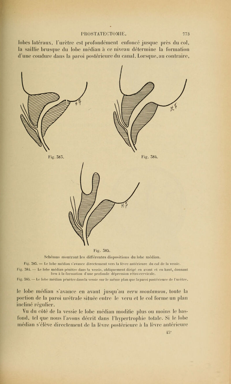 lobes latéraux, l'urètre est profondément enfoncé jusque près du col, la saillie brusque du lobe médian à ce niveau détermine la formation d'une coudure dans la paroi postérieure du canal. Lorsque, au contraire, Fig. 385. 584. Fig. 585. Schémas montrant les différentes dispositions du lobe médian. Fig-. 385. — Le lobe médian s'avance directement vers la lèvre antérieure du col de la vessie. Fig. 384. — Le lobe médian pénètre dans la vessie, obliquement dirigé en avant et en haut, donnant lieu à la formation d'une profonde dépression rétro-cervicale. Fig. 383. — Le lobe médian pénètre dans la vessie sur le même plan que la paroi postérieure de l'urètre. le lobe médian s'avance en avant jusqu'au veru monlanum, toute la portion de la paroi urétrale située entre le veru et le col forme un plan incliné régulier. Vu du côté de la vessie le lobe médian modifie plus ou moins le bas- fond, tel que nous l'avons décrit dans l'hypertrophie totale. Si le lobe médian s'élève directement de la lèvre postérieure à la lèvre antérieure