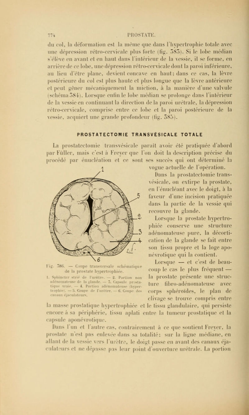 du col, la déformation est la même que dans l'hypertrophie totale avec une dépression rétro-cervicale plus forte (fig. 583). Si le lobe médian s'élève en avant el en haut dans l'intérieur de la vessie, il se forme, en arrièrede ce lobe, une dépression rétro-cervicale dont la paroi inférieure, au lieu d'être plane, devient concave en haut: dans ce ras. la lèvre postérieure du col est plus haute et plus longue que la lèvre antérieure et peut gêner mécaniquement la miction, à la manière d'une valvule (schéma58 I . Lorsque enfin le lobe médian se prolonge dans l'intérieur de la vessie en continuant la direction de la paroi urétrale, la dépression rétro-cervicale, comprise entre ce lobe el la paroi postérieure de la vessie, acquiert une grande profonde!» (fig. 585). PROSTATECTOMIE TRANSVÉS ICALE TOTALE La prostatectomie Iransvésicale parait avoir été pratiquée d'abord par Fuller. ruais c'esl a Freyer que Ton doit la description précise du lé par énucléalion et ce sont ses succès qui ont déterminé la vogue actuelle de l'opération. Mans la prostatectomie Irans- vésicale, on extirpe la prostate. en l'énucléanl avec le doigt, à la faveur d'une incision pratiquée dans la partie de la vessie qui recouvre la -lande. Lorsque la prostate hypertro- phiée conserve une structure adénomateuse pure, la décorti- cation de la glande se fait entre son tissu propre et la loge apo- névrotique qui la contient. Lorsque — »'t c'est de beau- coup h1 cas le plus fréquent — la prostate présente une struc- ture ûbro-adénomateuse ;i\»''- corps sphéroïdes, le plan de clivage se trouve compris entre l.i masse prostatique hypertrophiée <•! \>- tissu glandulaire, qui persiste encore ;'i -;i périphérie, tissu aplati entre la tumeur prostatique <'i la capsule aponévrotique. Dans l'un »'t l'autre cas, contrairement ;'i <■«■ que soutient Freyer, la prostate n'est p;<- enlevée dans sa totalité; sur la ligne médiane, en allant de la vessie \ irs lu ètr ■. le doigl passe en avant des canaux éja- culateurs el ne dépasse pas leur point d'ouverture urétrale. La portion . N- — pe transvei - - na tique i prostate hypertroph — '2. Portion non - I a hyper- ipe des -